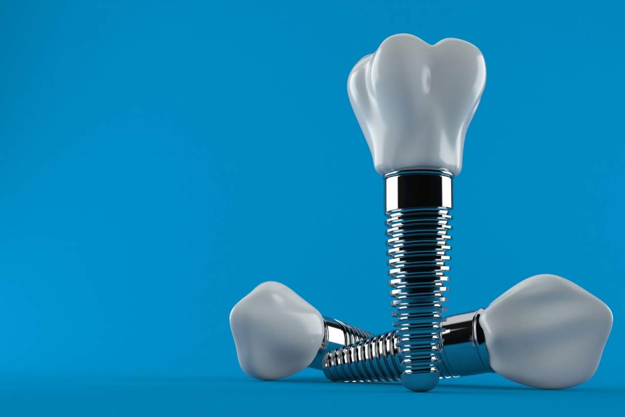 Conoce el precio de un implante dental en Sevilla