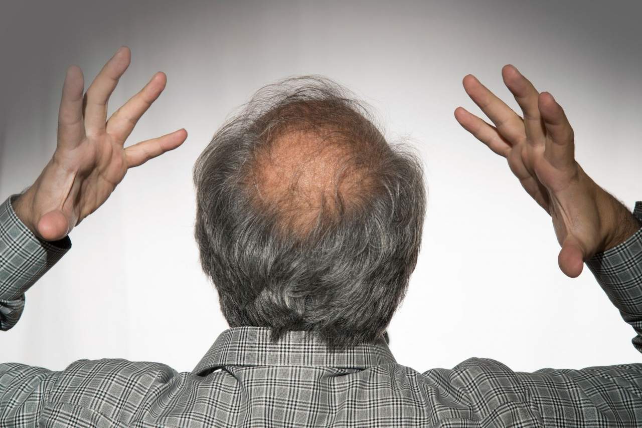 ¿Cómo prevenir alopecia androgenética?, según Natura Estilo