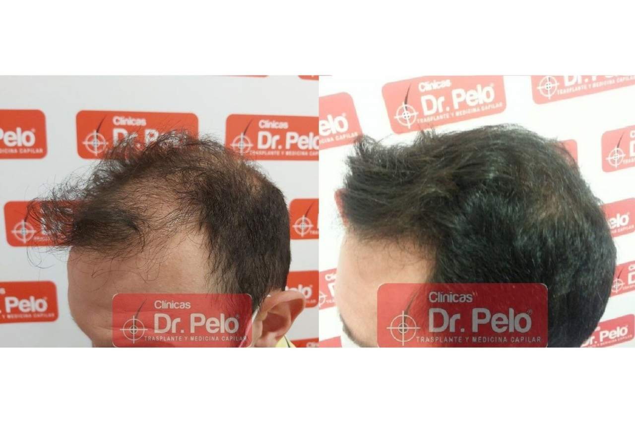 Señales de alopecia Dr. Pelo