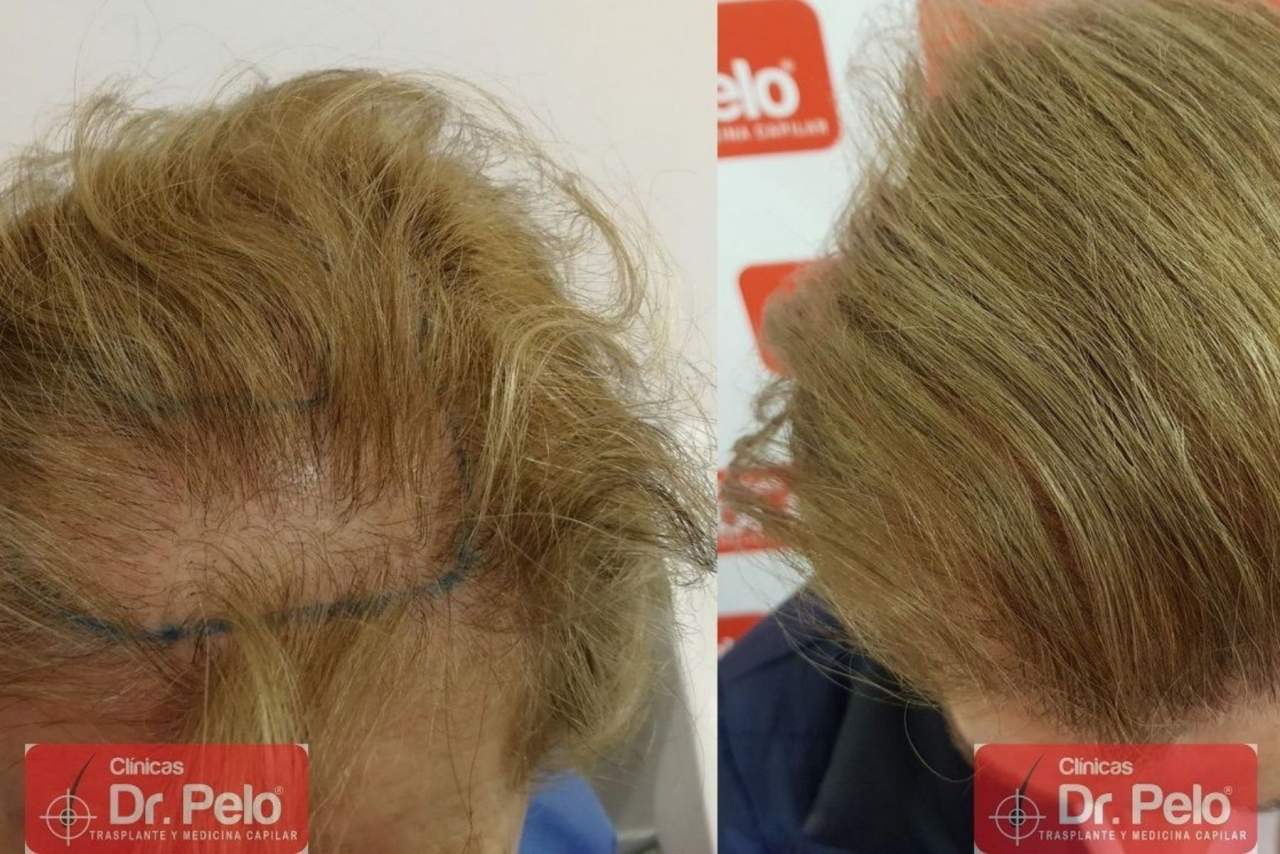 Injerto capilar Sevilla en la Clínica Dr. Pelo