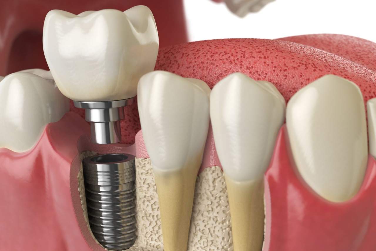 Helident Training Center: ¿Los implantes duran para siempre?¿Qué cuidados necesitan?