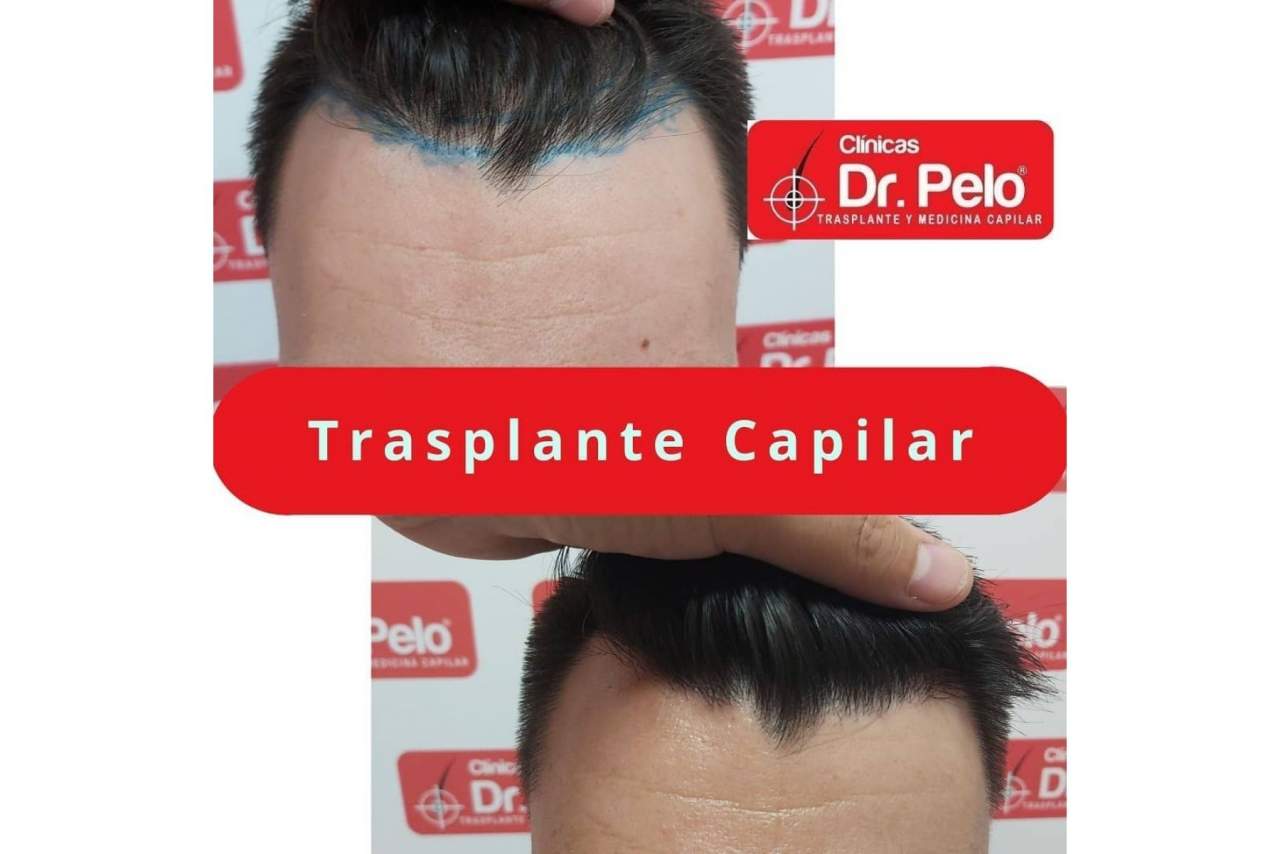 Opiniones sobre el injerto capilar de las Clínicas Dr. Pelo en Sevilla