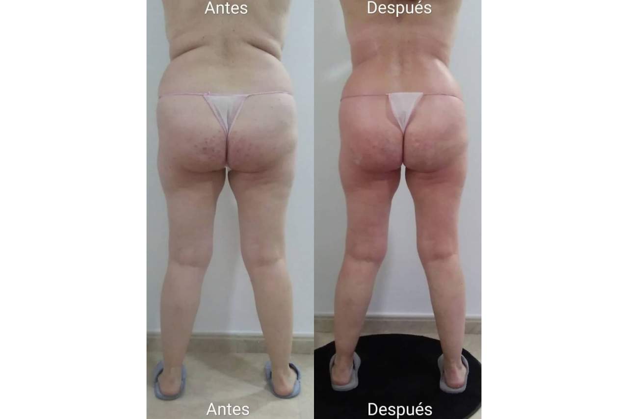 Triple R, el tratamiento reductor en Valencia diseñado por Vanesa Vendrell