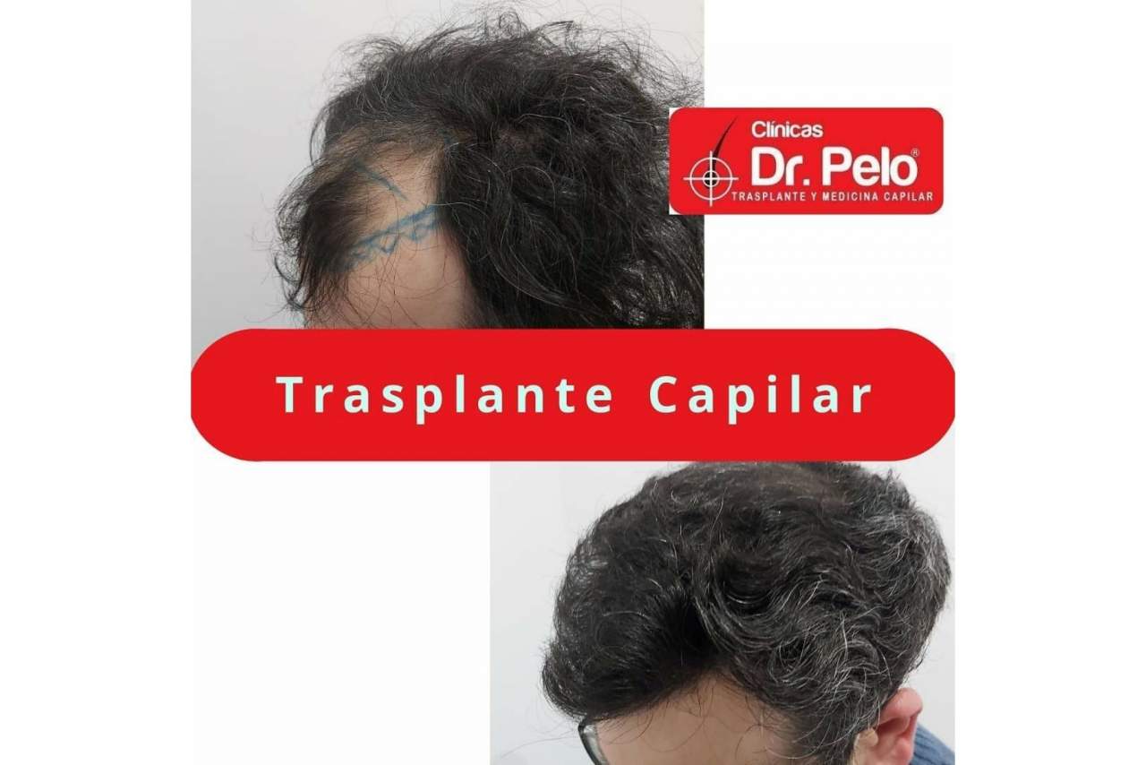 El trasplante capilar en España gana popularidad en los últimos años tras mejorar los precios y las técnica aplicadas