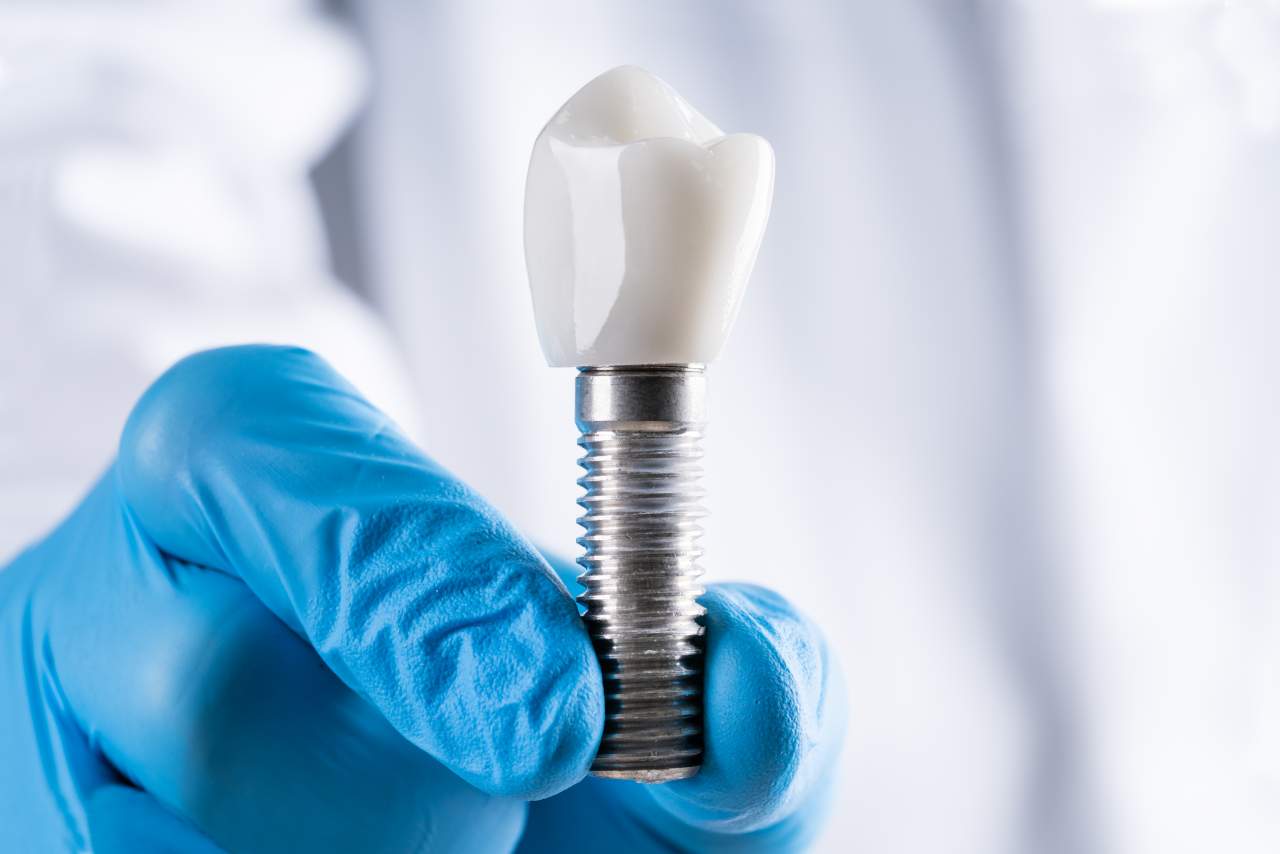 Dentistas de la Clínica Helident Sevilla: es recomendable el uso de la mejor calidad en implantes