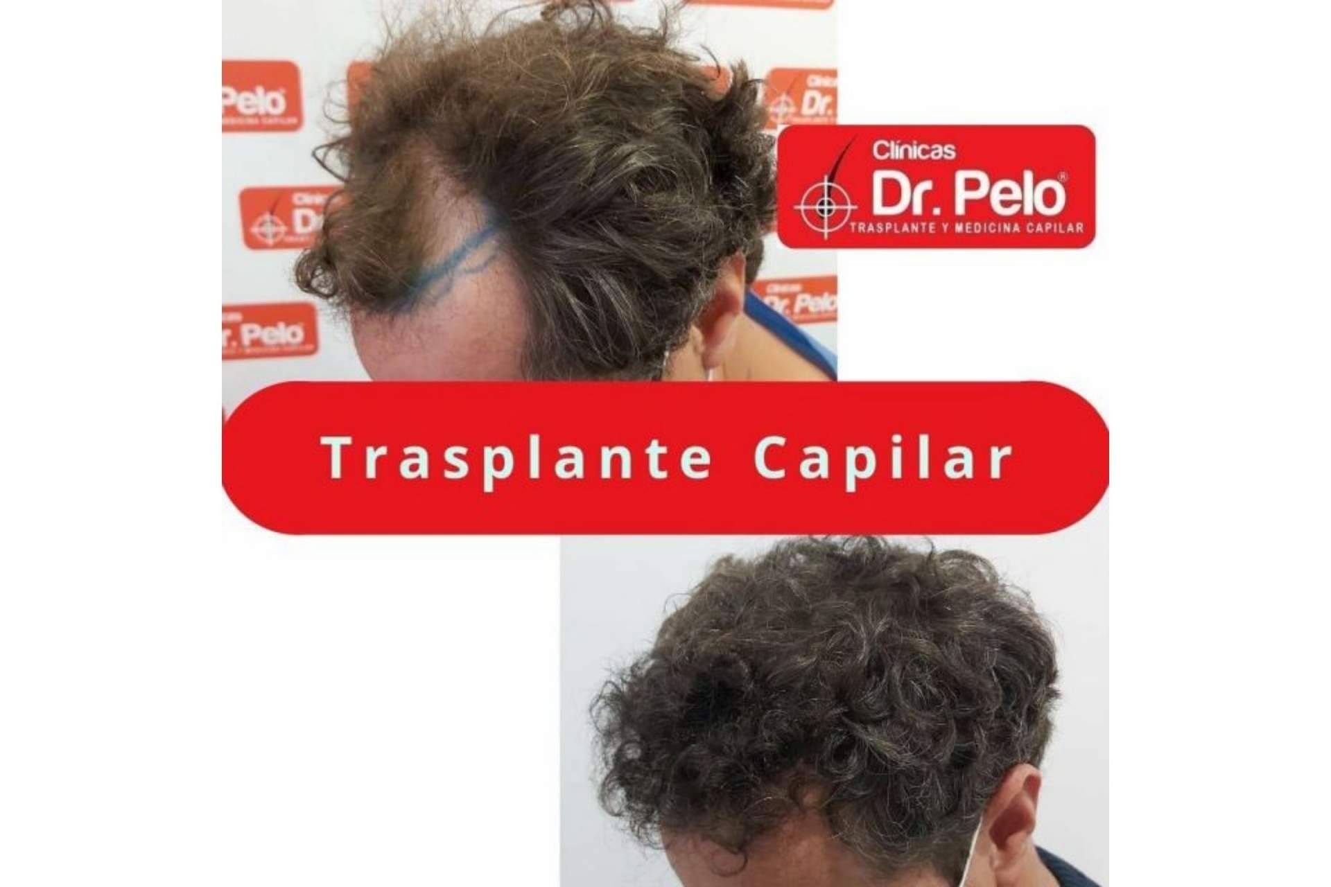 El tratamiento de injerto capilar en Sevilla gana popularidad gracias a las Clínicas Dr. Pelo