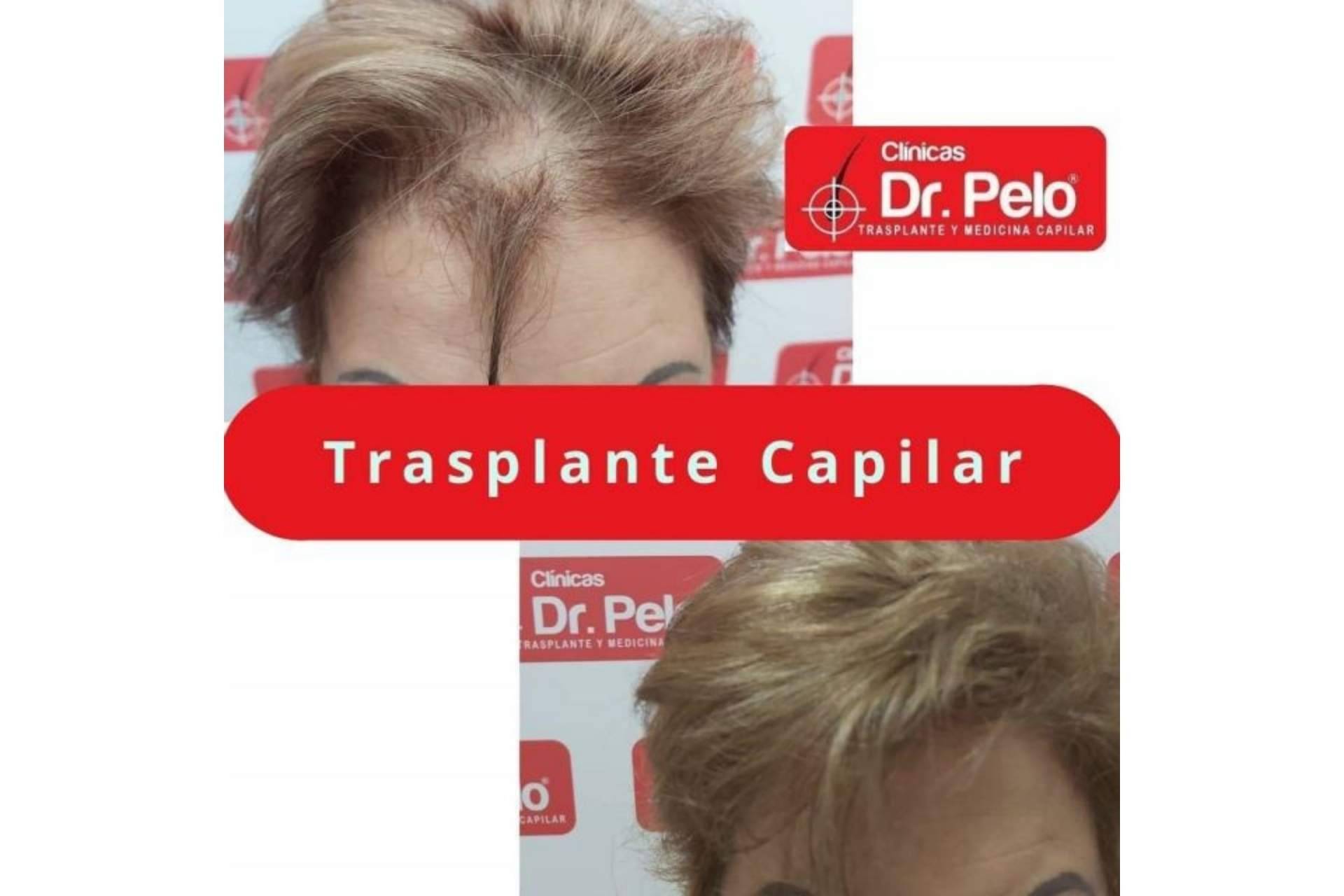 Frenar las entradas en el pelo gracias a los tratamientos de las Clínicas Dr. Pelo