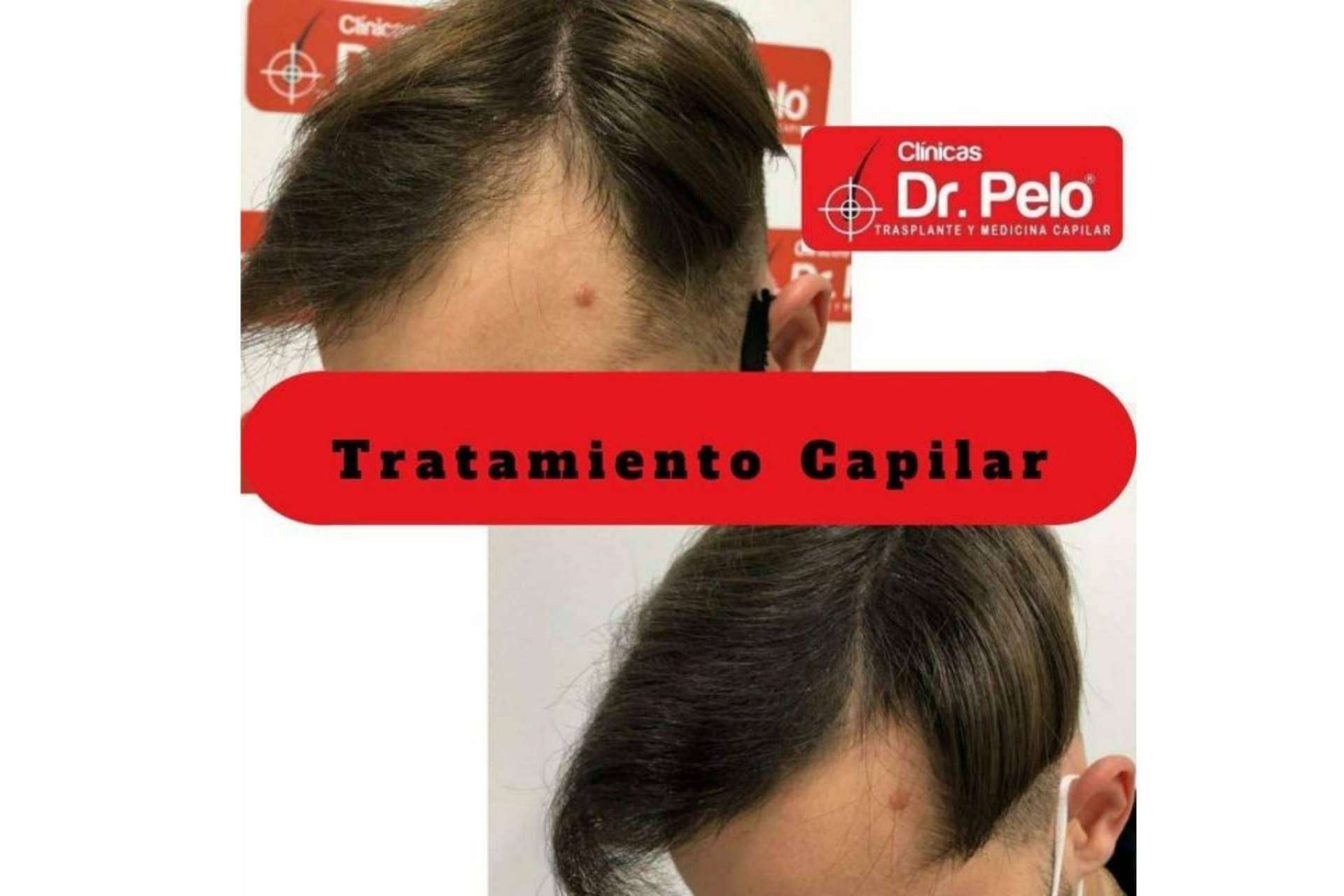 Clínica Dr. Pelo: centro recomendado para obtener los mejores resultados de trasplante capilar en España