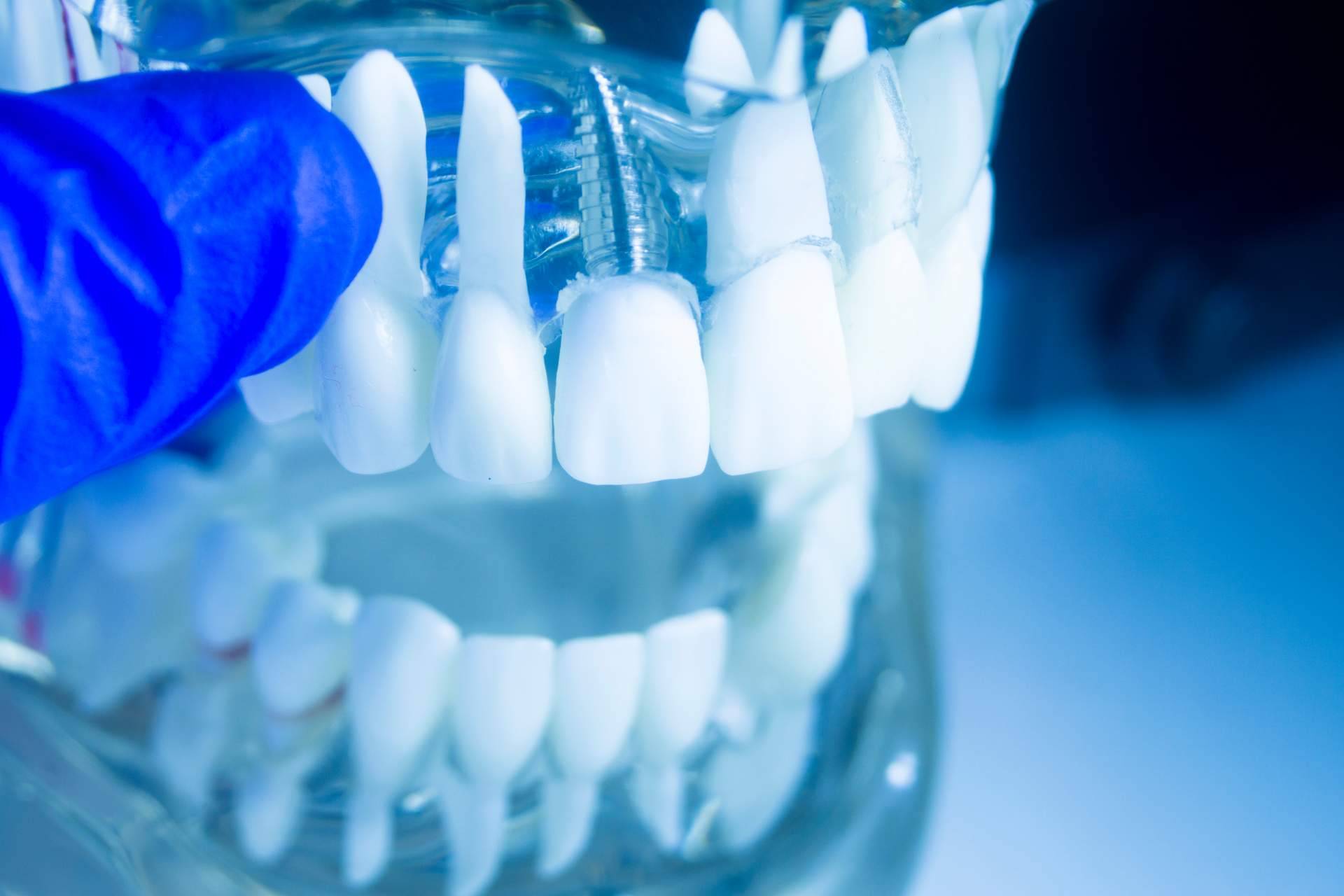 Dientes fijos en un día: la realidad de la mano de la Clínica dental especializada Artydents en Madrid