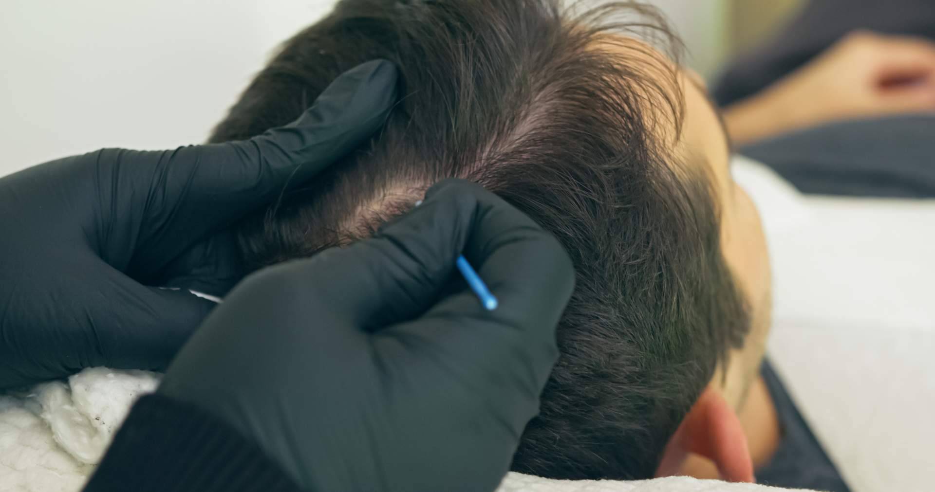 ¿Qué es la micropigmentación capilar?: Distrito Wellness Concept ofrece solución a los problemas de pérdida de cabello