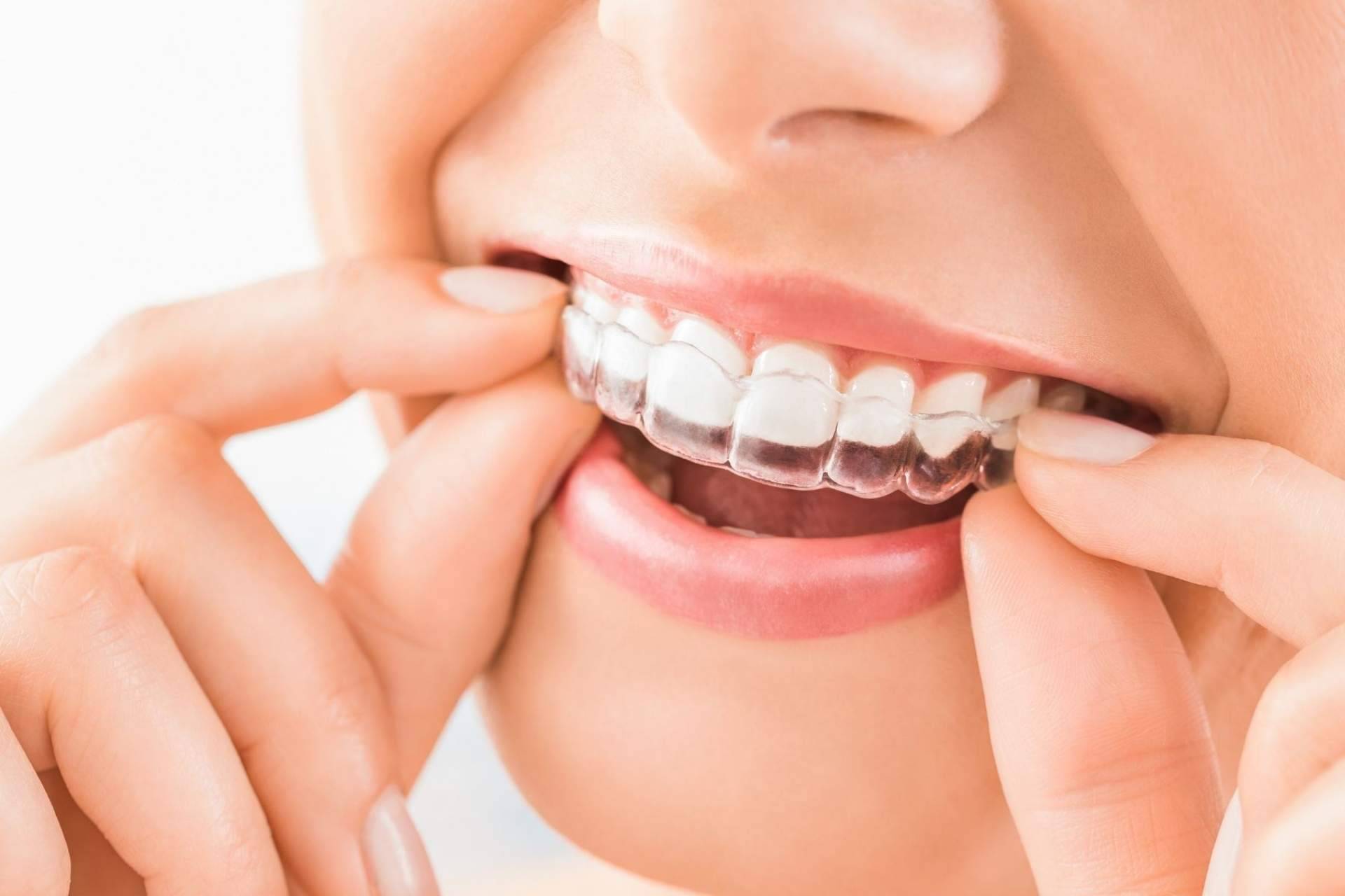 ¿La estética dental ofrece un efecto rejuvenecedor? Clínica Viasalud