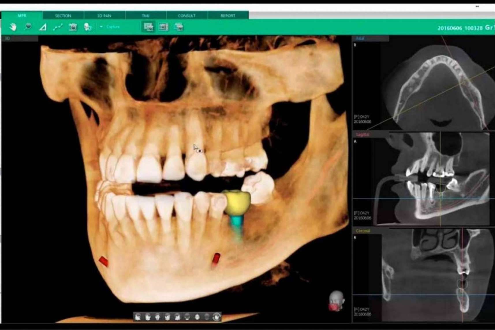 Odontología digital de la mano de Clínica Blay Monzó: las técnicas avanzadas en implantología