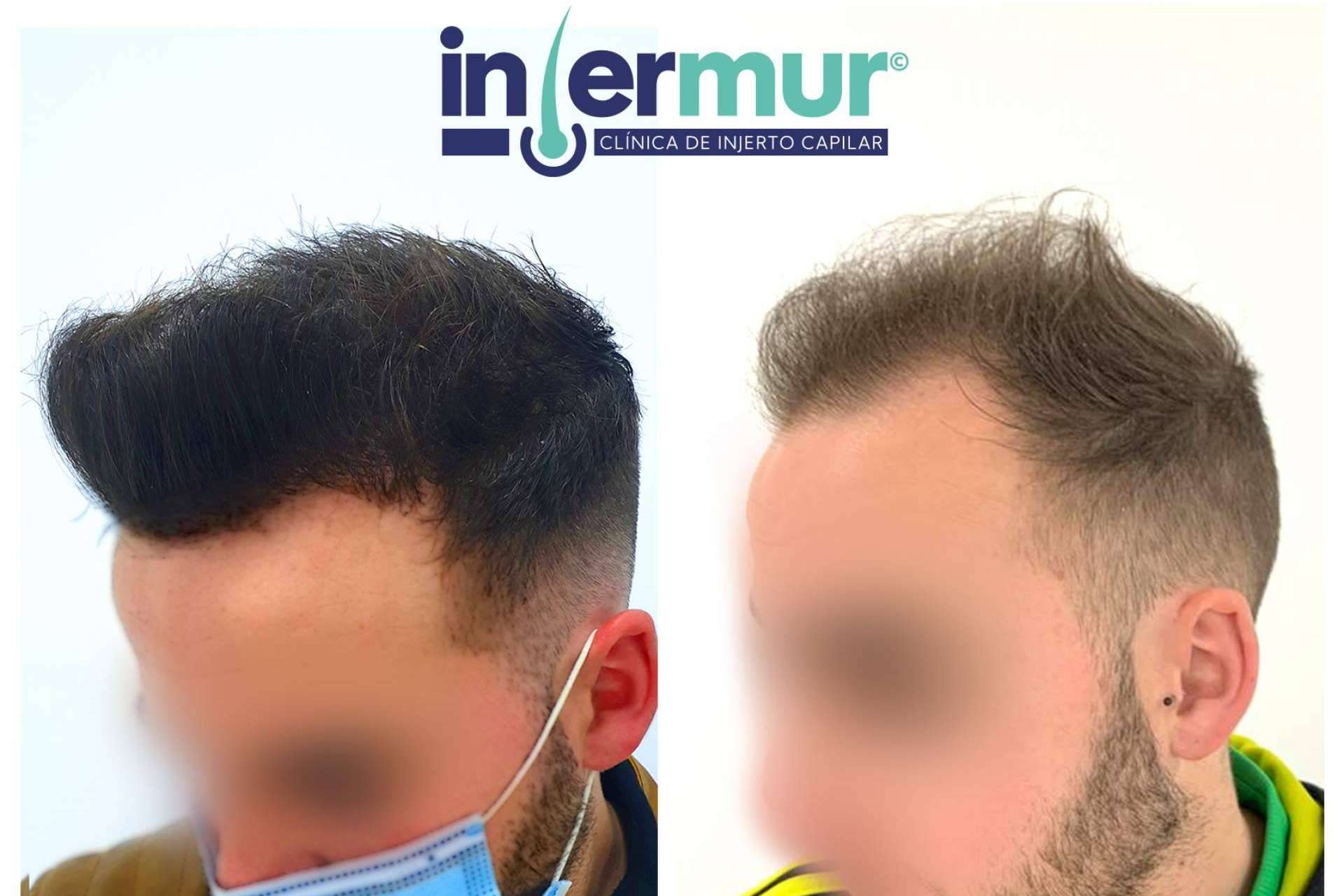 La clínica Injermur ofrece una técnica de injerto capilar que permite operaciones sin cicatriz