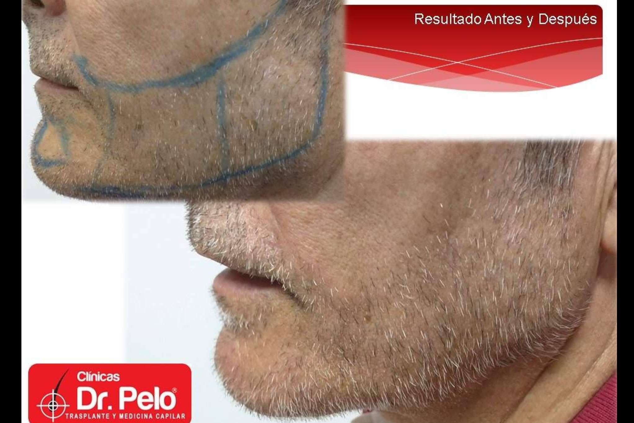 Clínicas Dr. Pelo: el trasplante de barba, uno de los tratamientos con resultados más satisfactorios