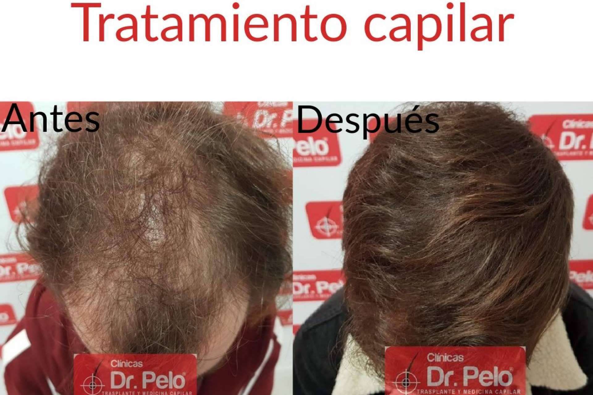 La red de Clínicas Dr. Pelo dispone de todo tipo de tratamientos capilares