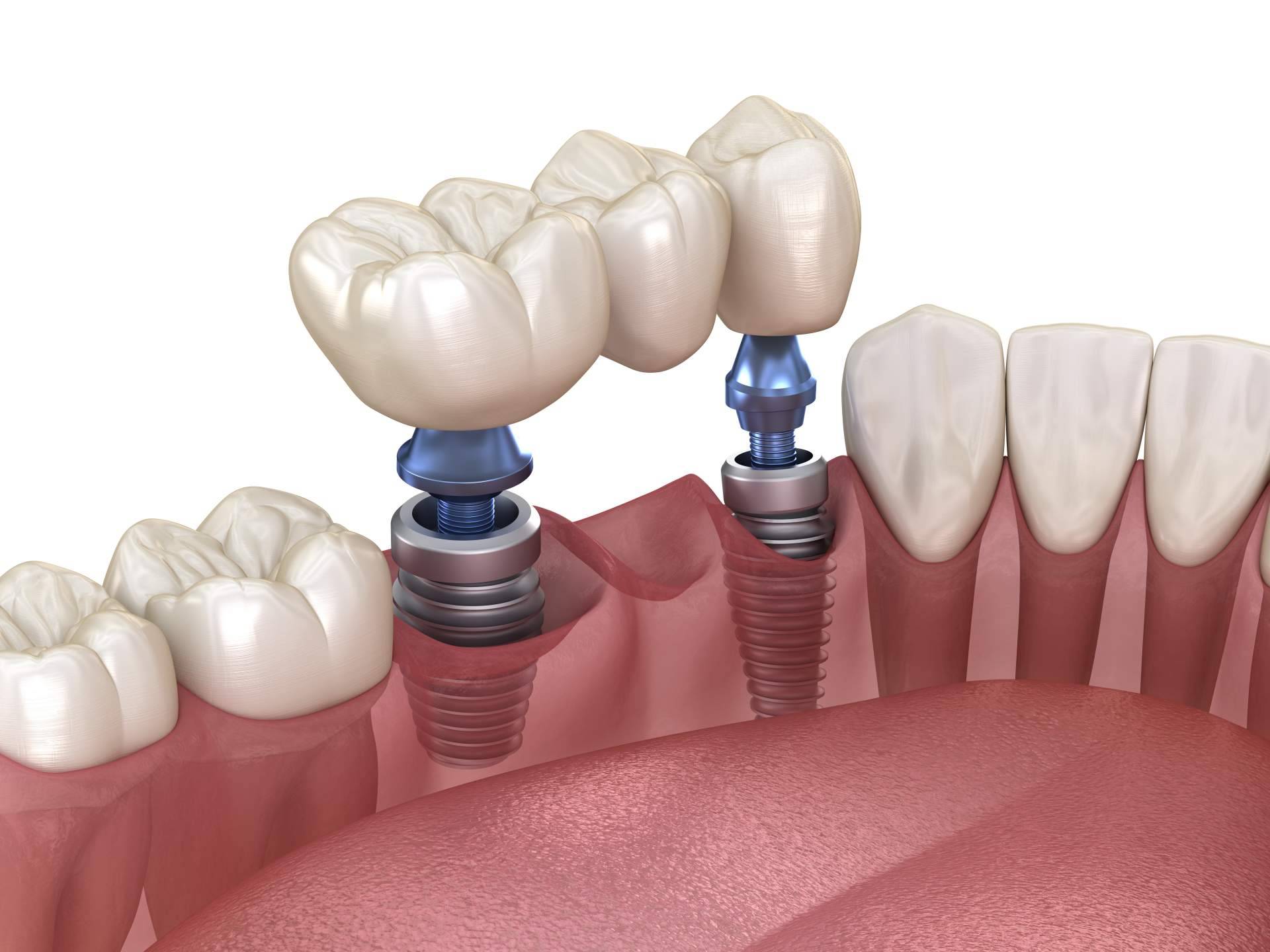 Implante dental de titanio en Sevilla en Clínica Dental Helident