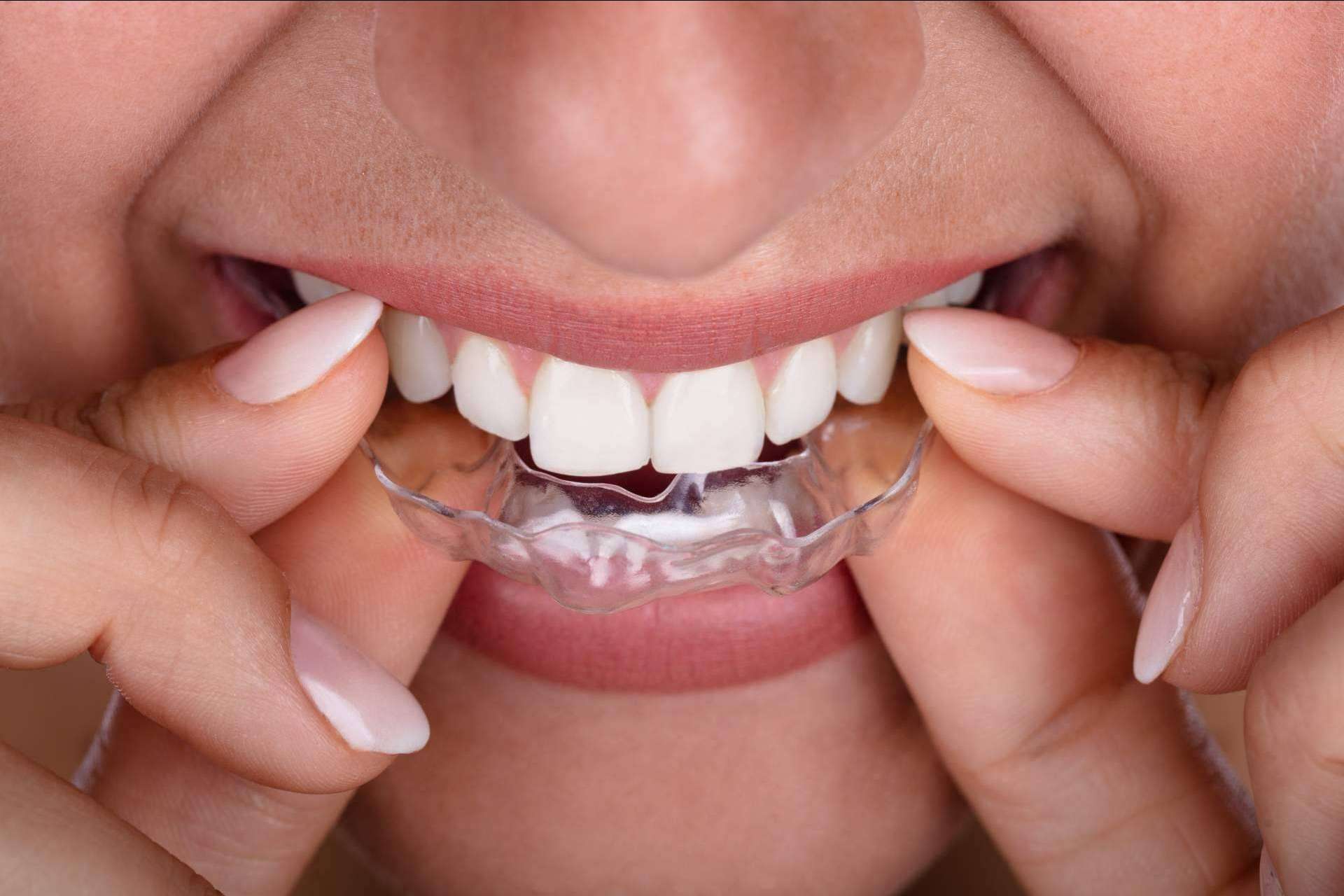 Los sistemas novedosos de Smile Aligner como ortodoncia invisible