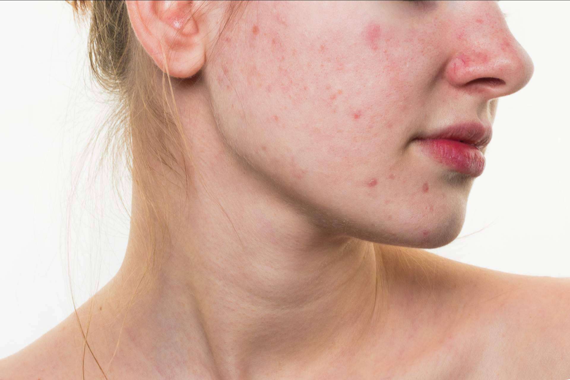 AcnéXero, la aplicación ideada por dermatólogos que propone soluciones efectivas contra el acné