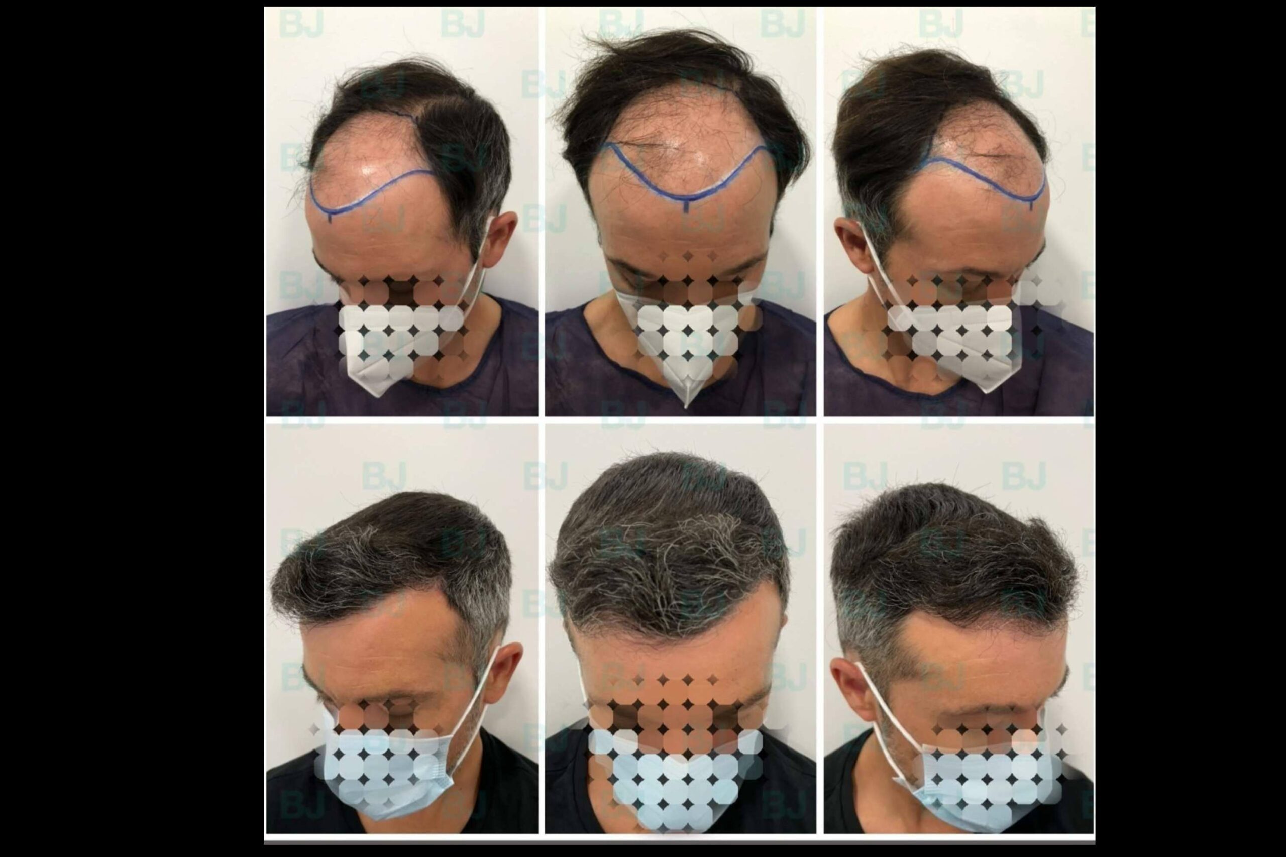Dr. Bruno Jacobovski, especialista en injerto capilar en Barcelona con más de 500 intervenciones exitosas