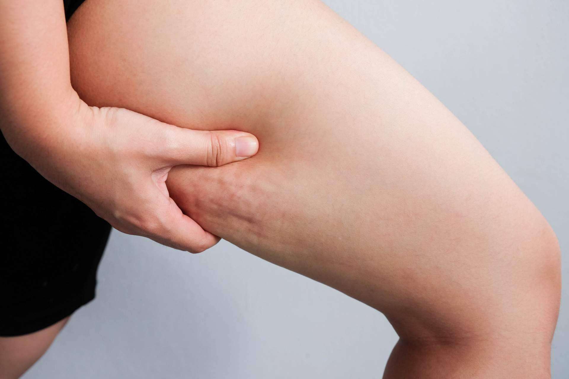 Sincelut Forte, una ayuda para combatir la celulitis de una forma natural