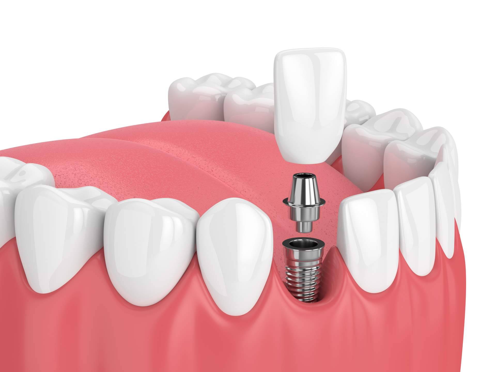 Clínicas Qualident ofrece implantes dentales innovadores en Hospitalet