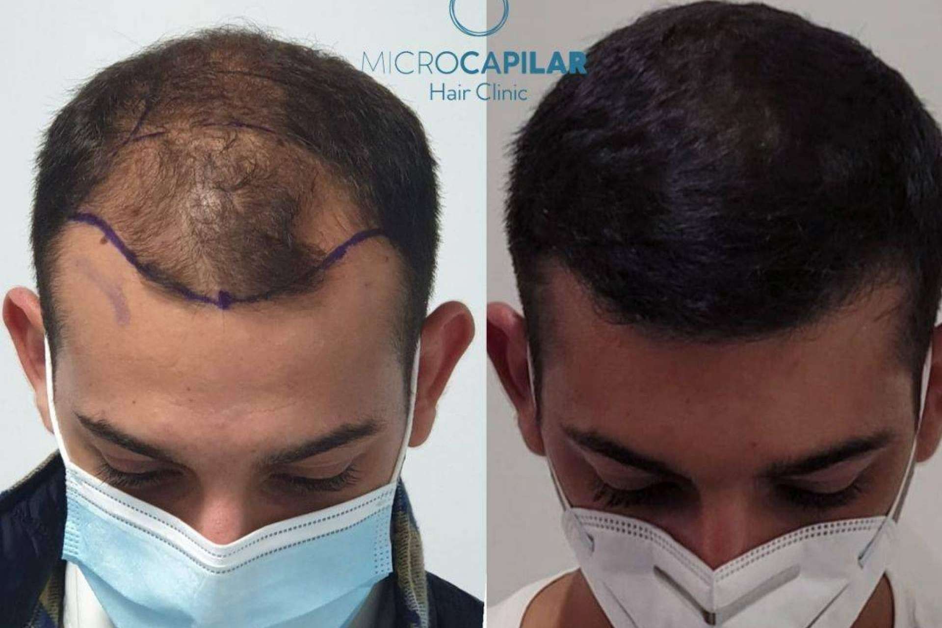 En qué lugar es posible realizarse un injerto capilar con máxima extracción folicular, Microcapilar Hair Clinic