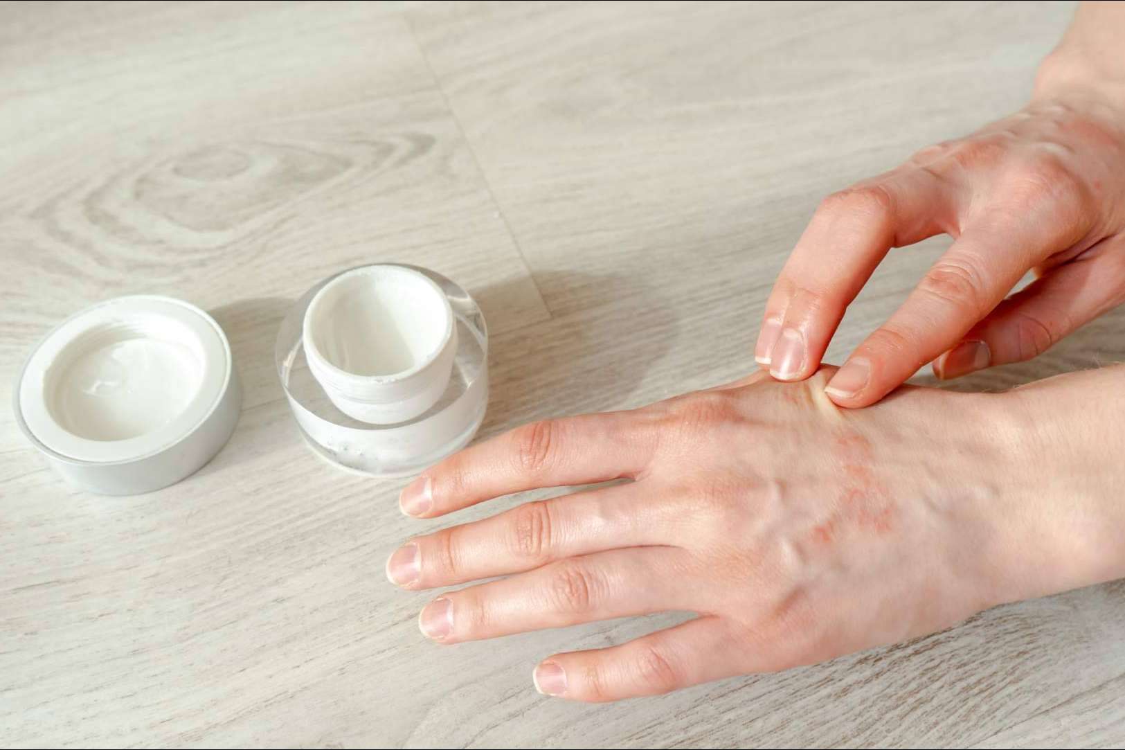 Laboratorio Géomer expone las diferencias entre un eczema atópico y un eczema de contacto