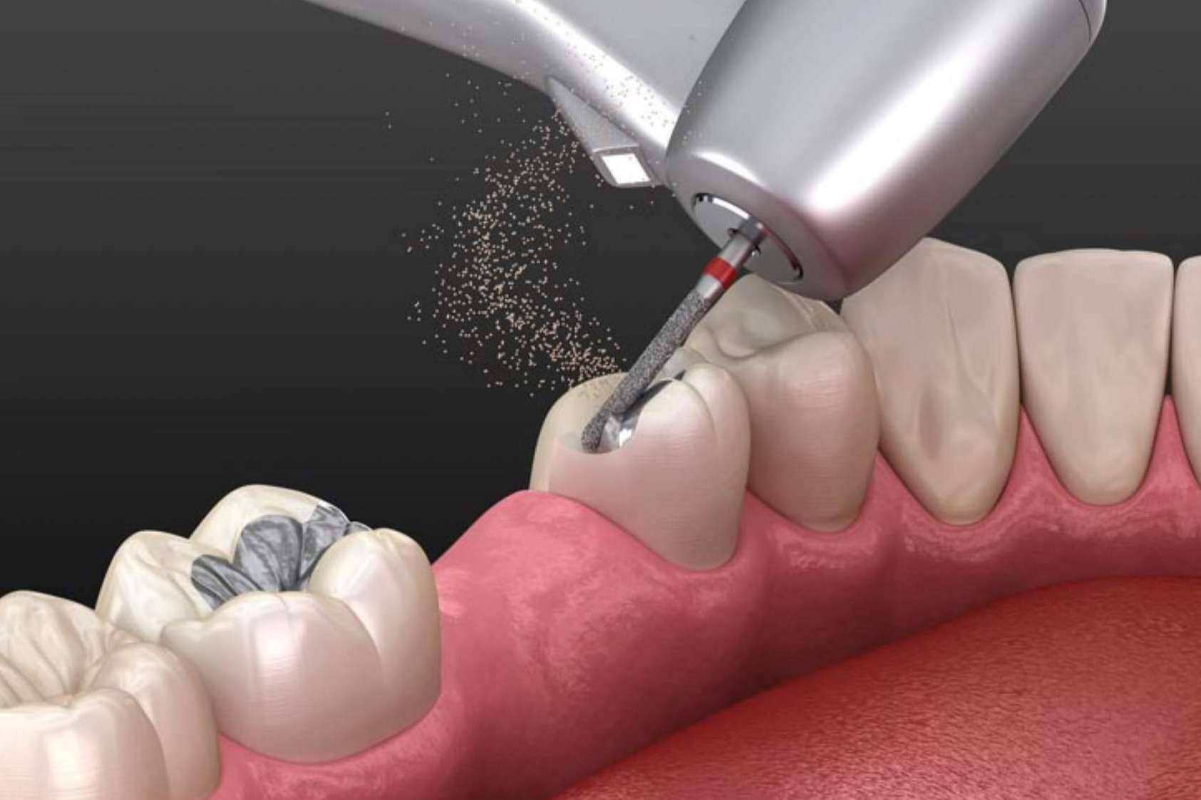 La calidad de las fresas dentales contribuye a que el instrumento dure más tiempo, según la empresa Precisión Médica Dental