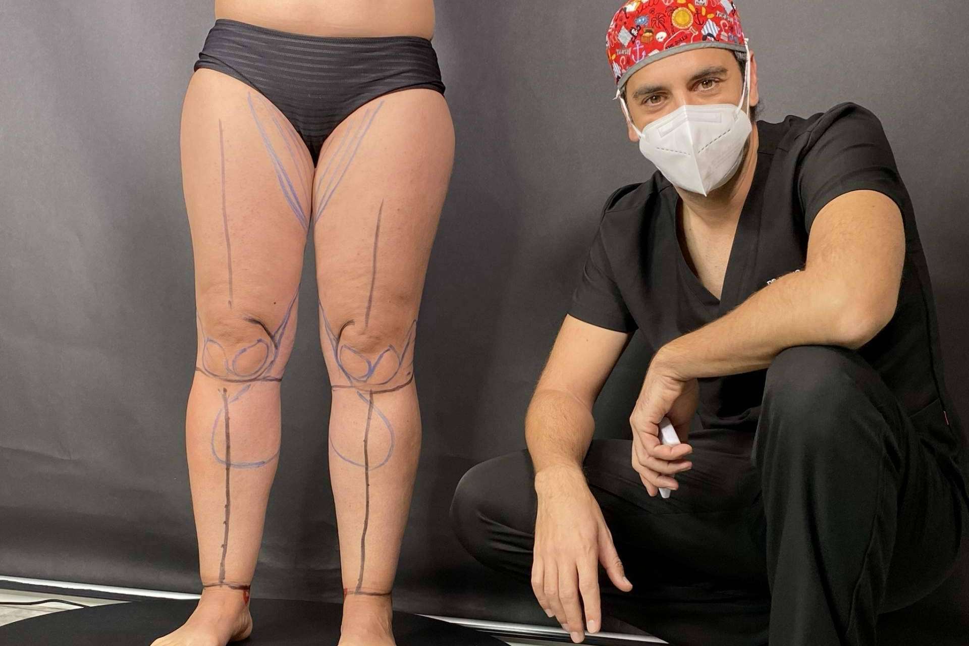 Nace el Instituto Valenciano de Lipedema IVALI
