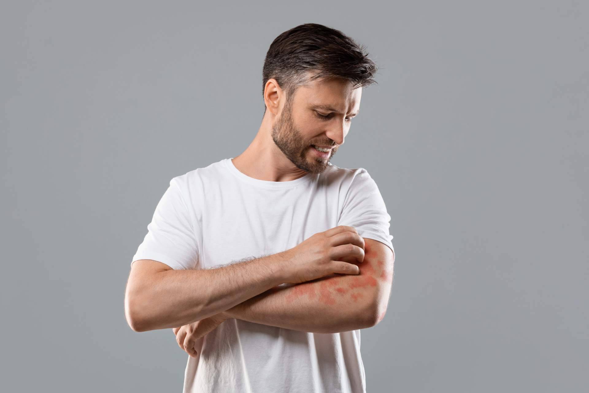 Tratamiento efectivo para la psoriasis con los productos de Soriasel