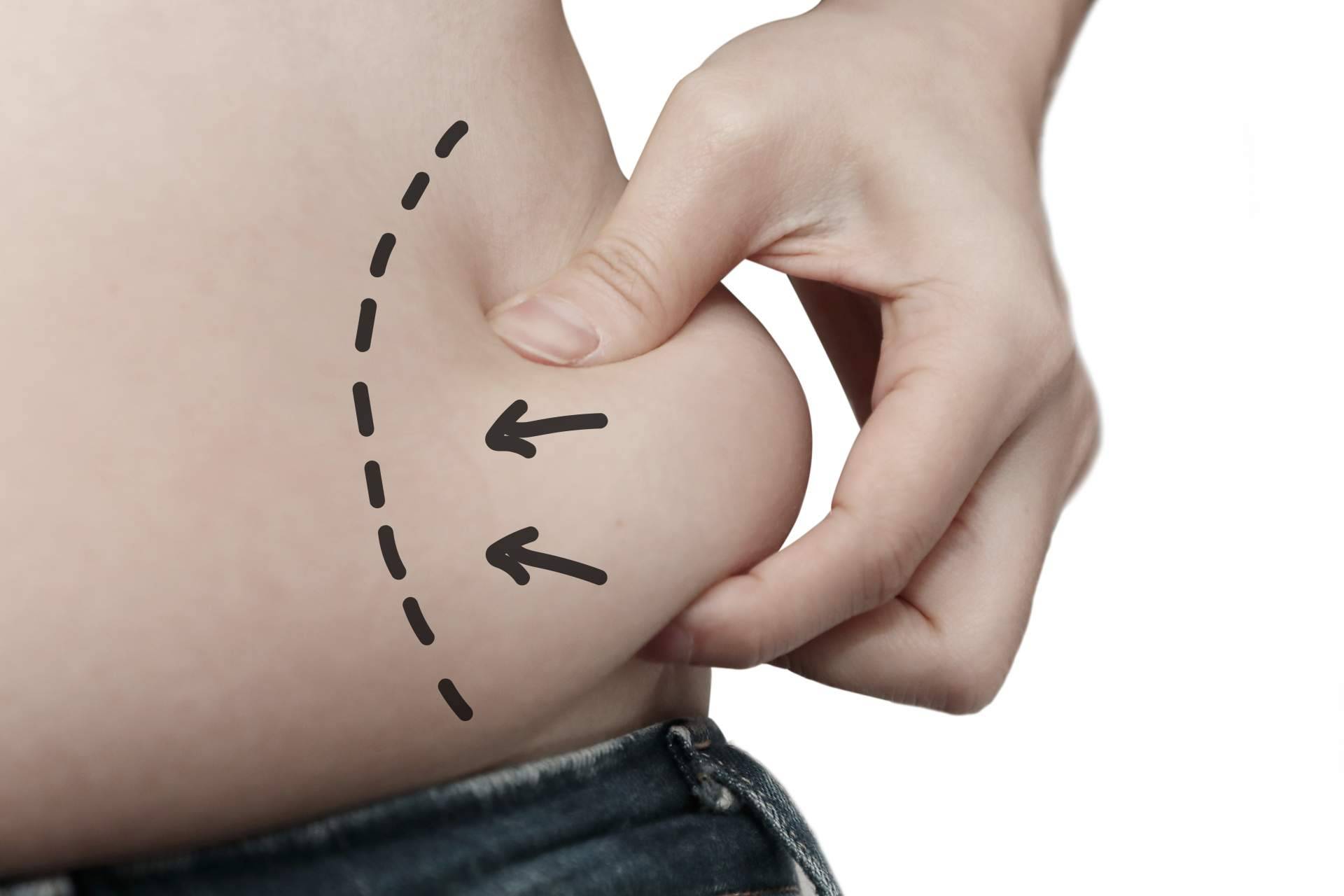 Los efectos del tratamiento de Velashape III de la Dra. Rigo