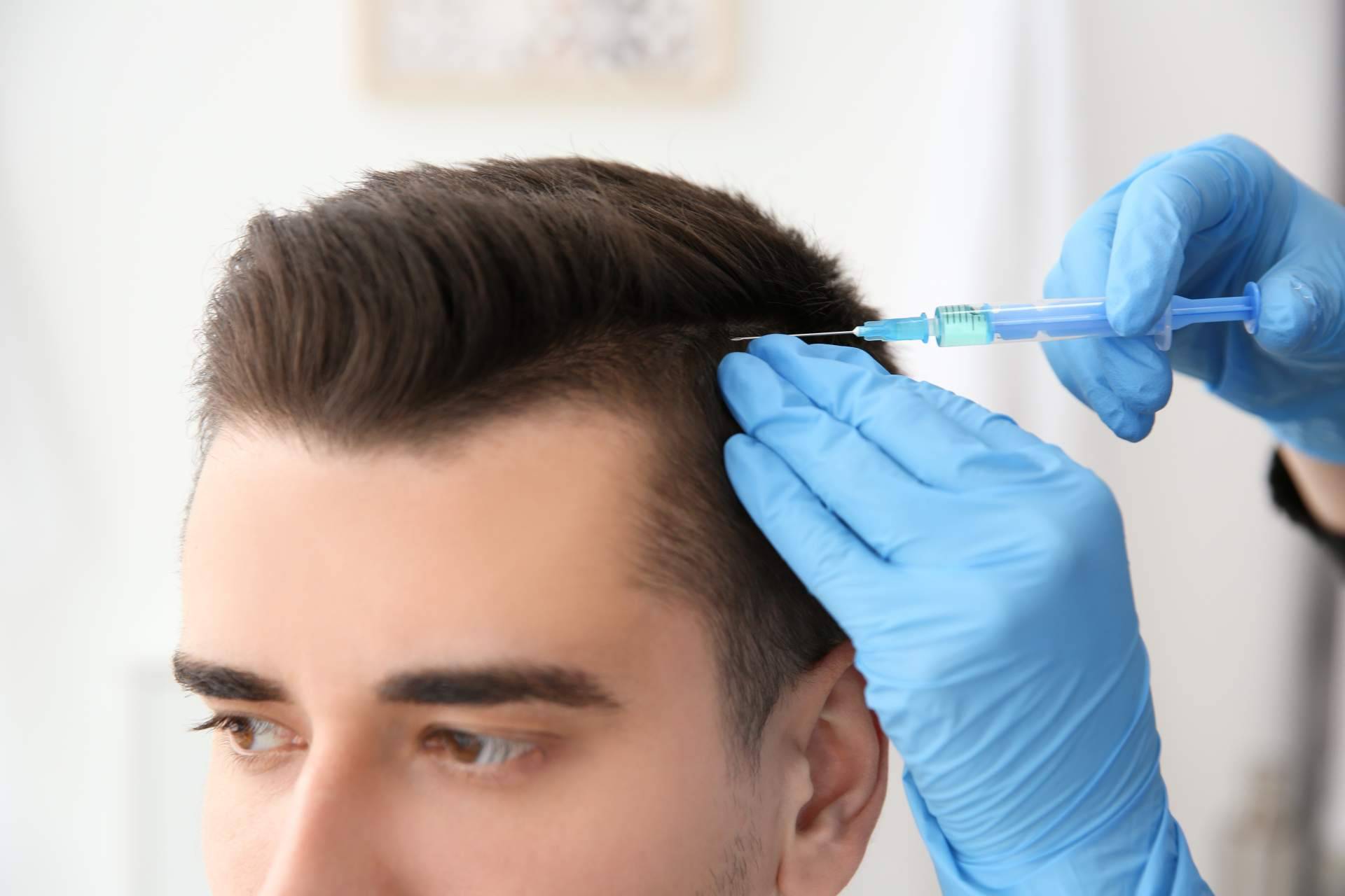 Nanofat, el tratamiento capilar de Clínica Tarrazo con el que es posible poner fin a la alopecia