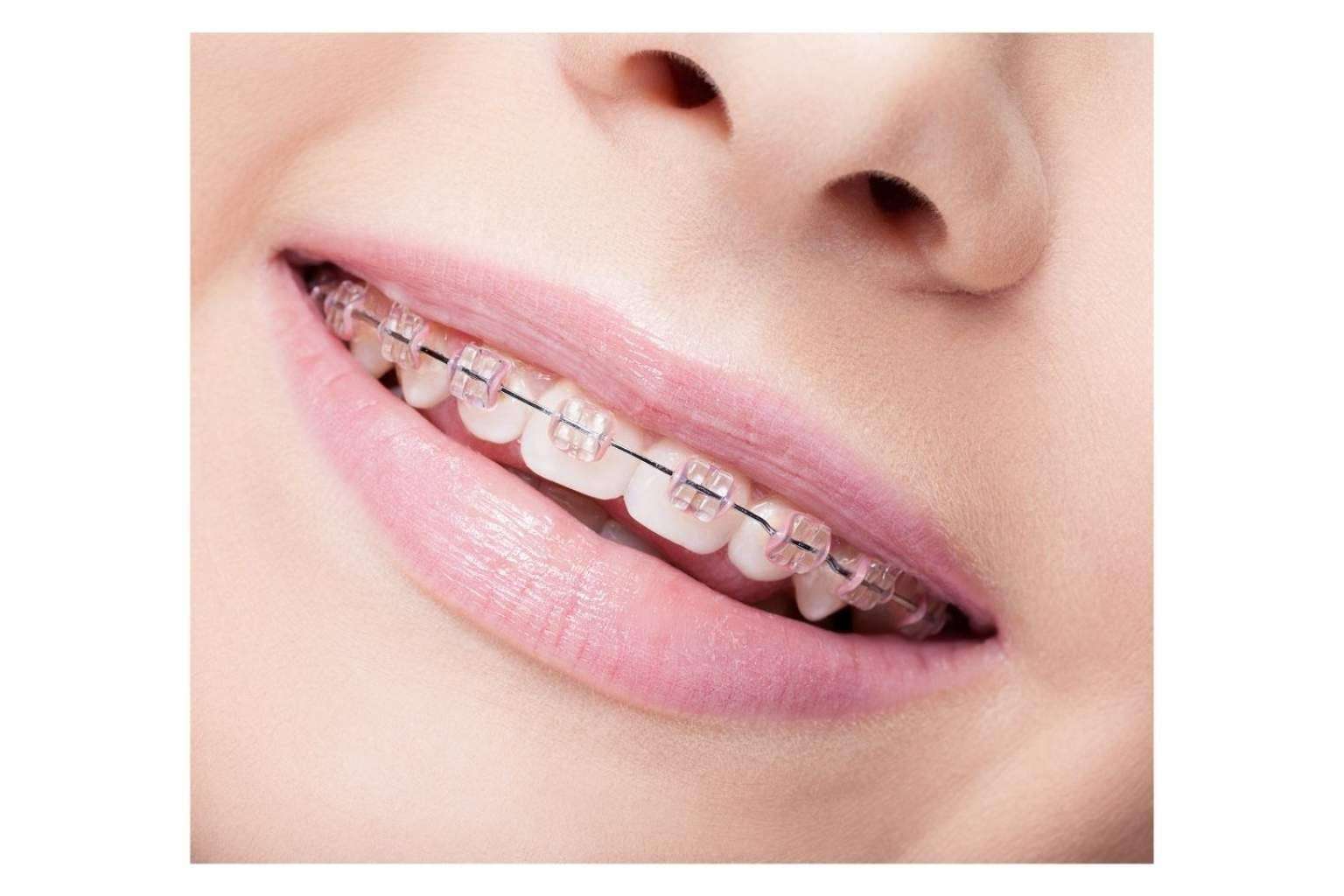 Witizz ofrece diferentes tipos de tratamiento de ortodoncia