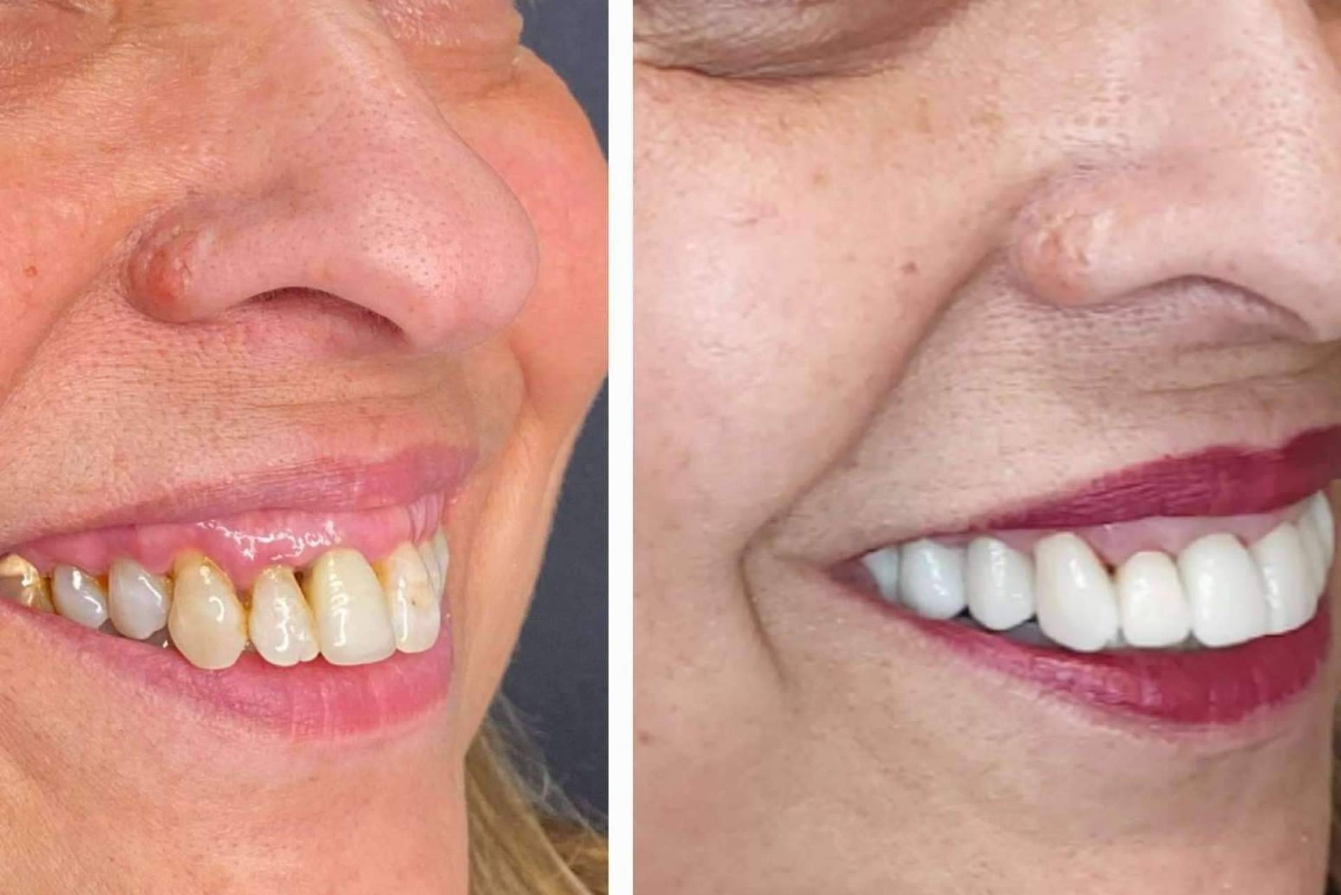 Todo lo que hay que saber acerca de las carillas dentales, por Dentinova