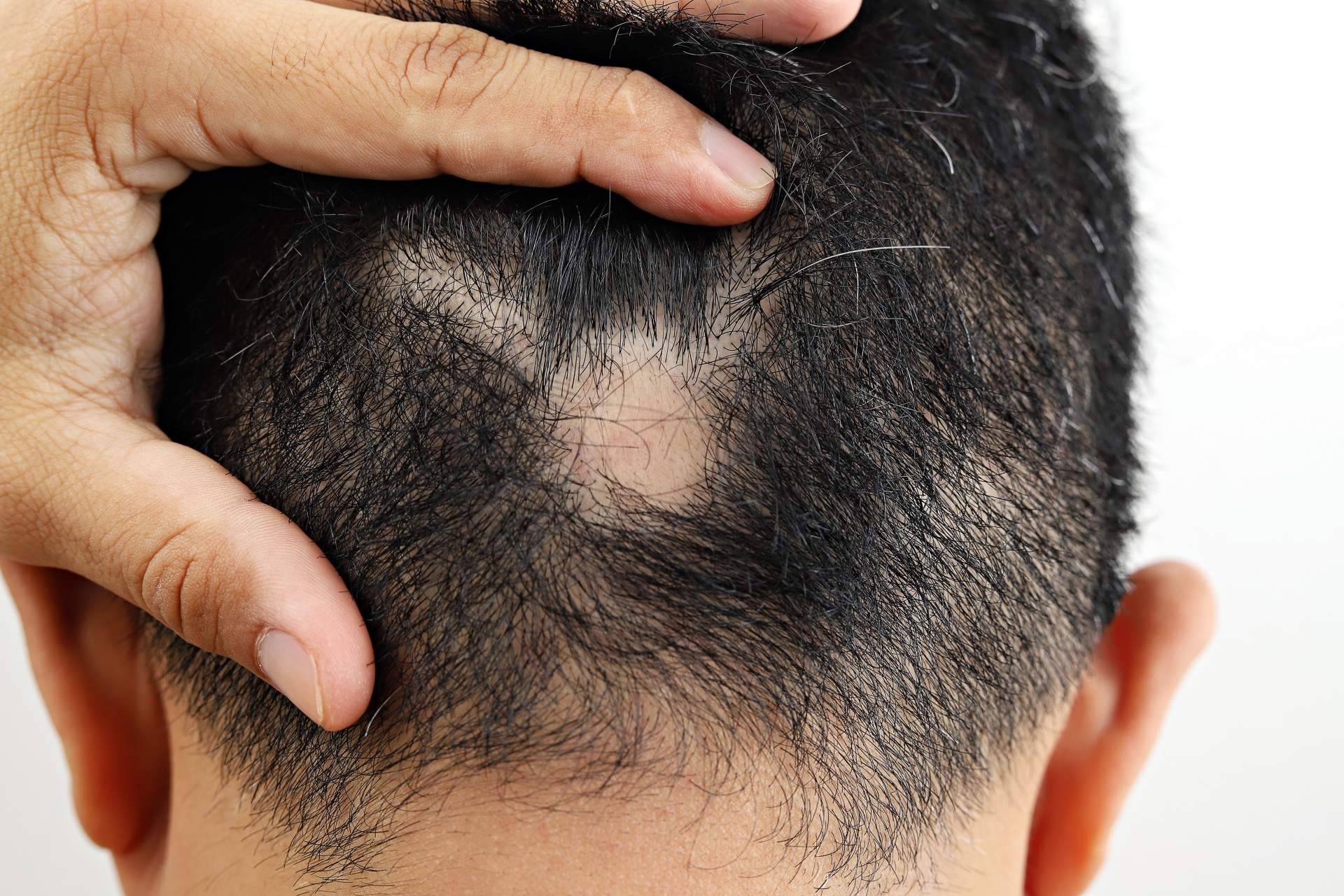 Saw Palmetto comercializa un tratamiento para alopecia areata