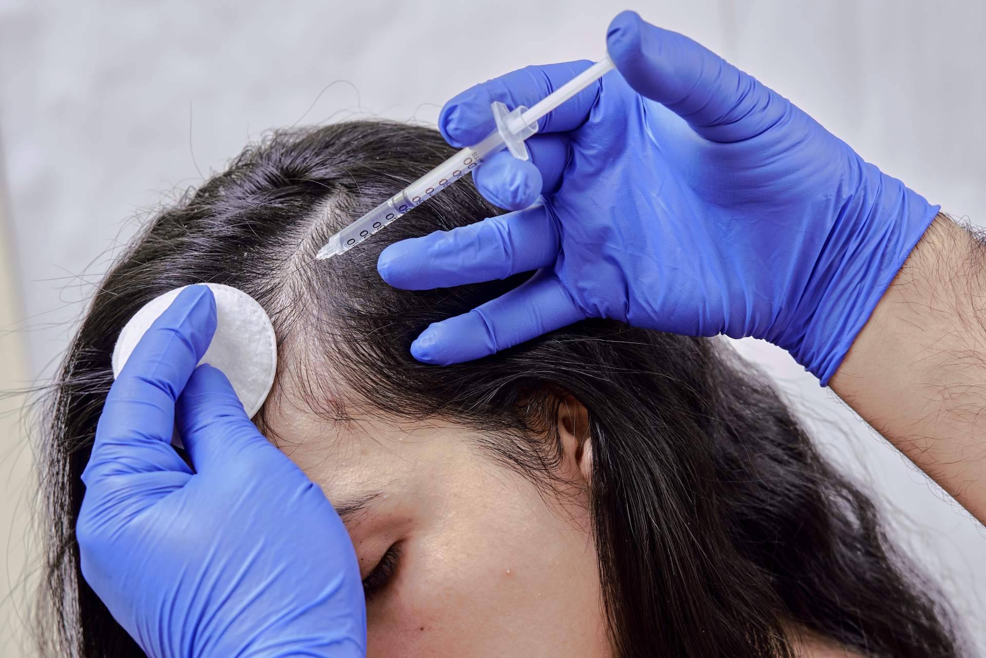 ¿En qué consiste, cuáles son los efectos y la recuperación de la mesoterapia capilar?, por Élite Capilar