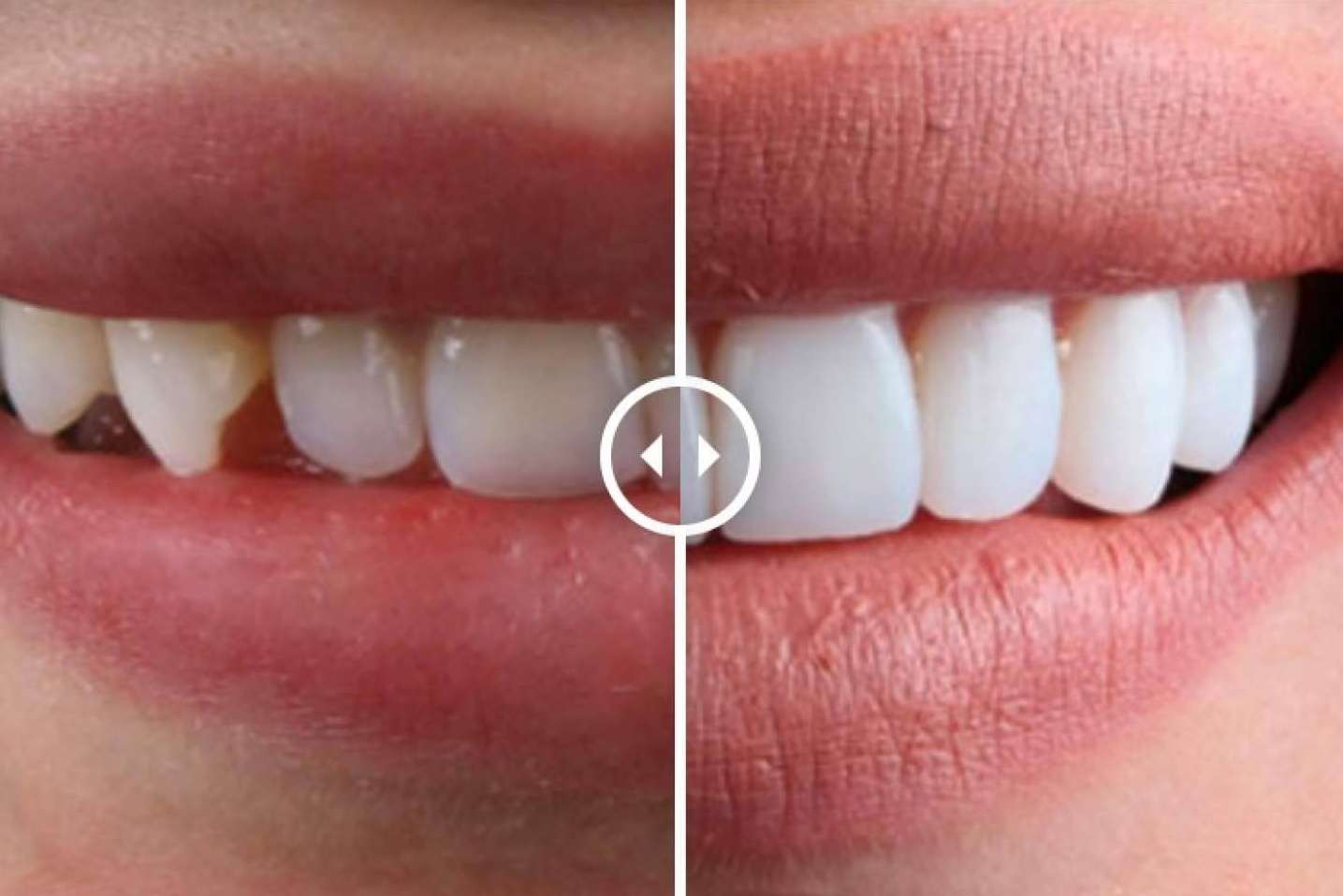 Todo lo que se debe saber acerca de las carillas dentales, según Crespí & Gandía