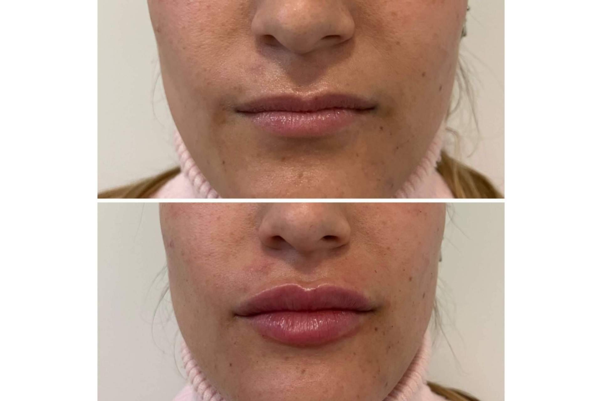 ¿Se puede lograr un aumento de labios en Madrid con resultados naturales?, por la Dra. Cecilia Arthur
