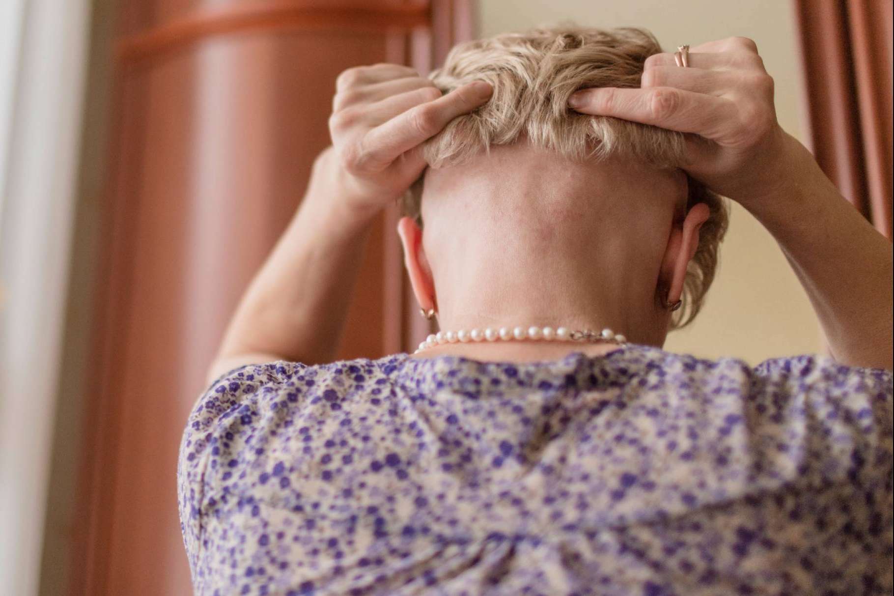 Las prótesis capilares son una alternativa a la pérdida de cabello