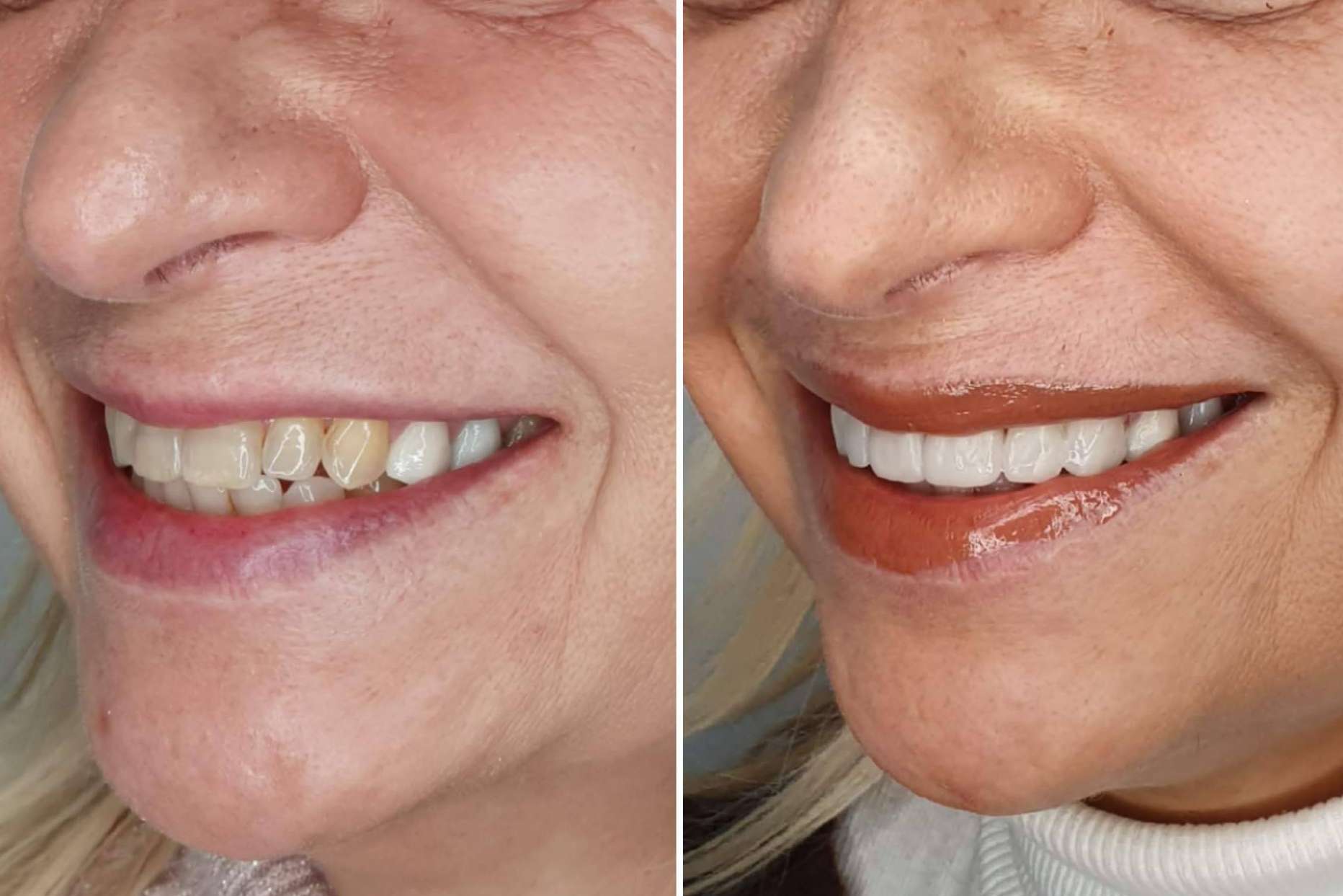 Tratamiento de alineación dentaria sin ortodoncia, por Dentinova