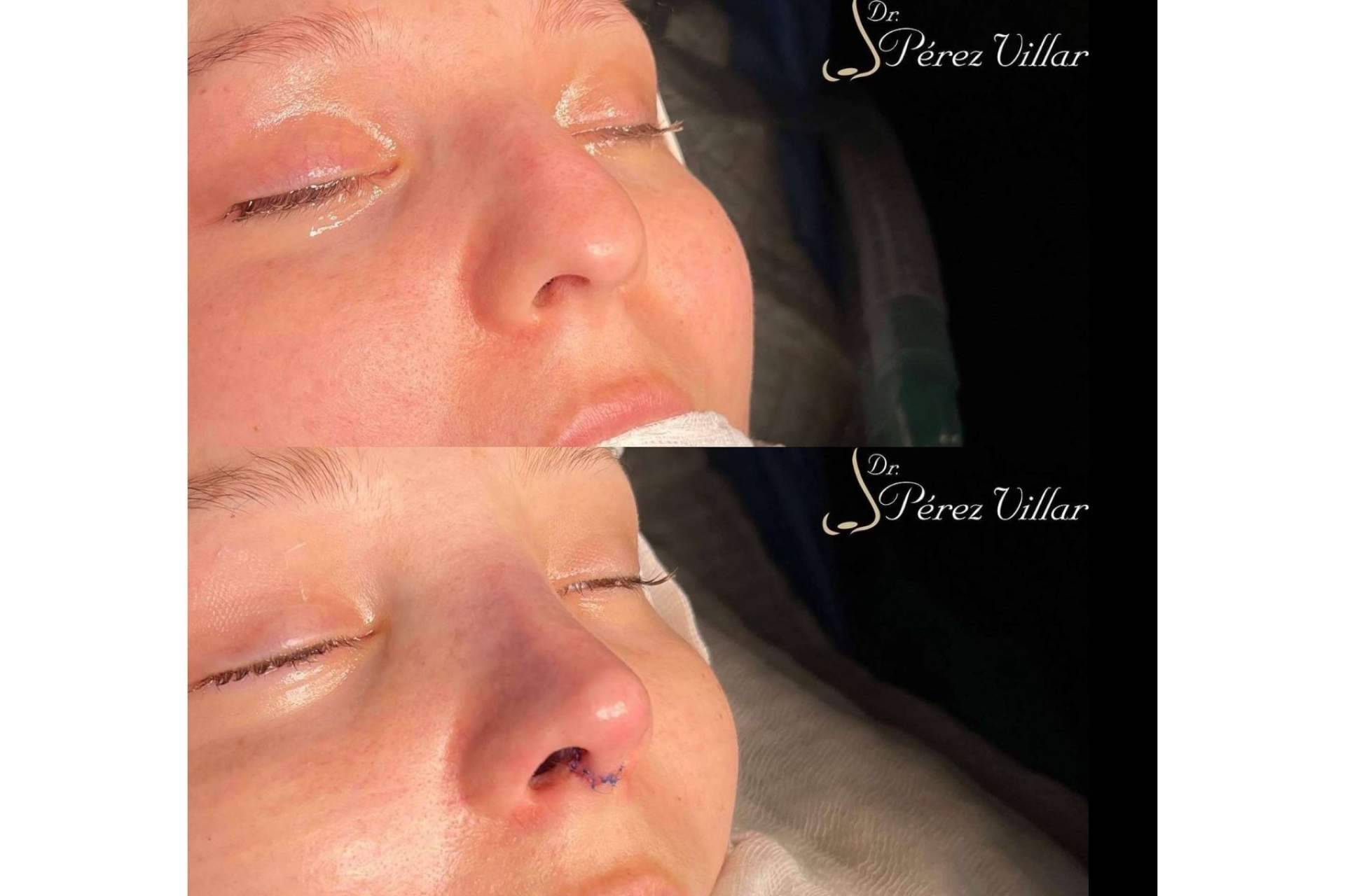 Dr. Álvaro Pérez-Villar Bonet indica por qué la rinoplastia ultrasónica de preservación es una técnica cada vez más presente en el mundo de la estética