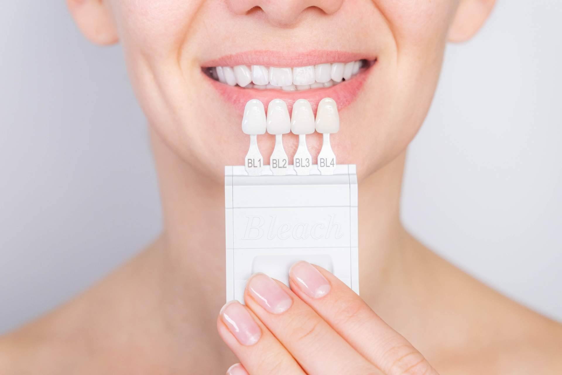 Mejorar la sonrisa de los pacientes con carillas dentales, Clínica Dental Delgado