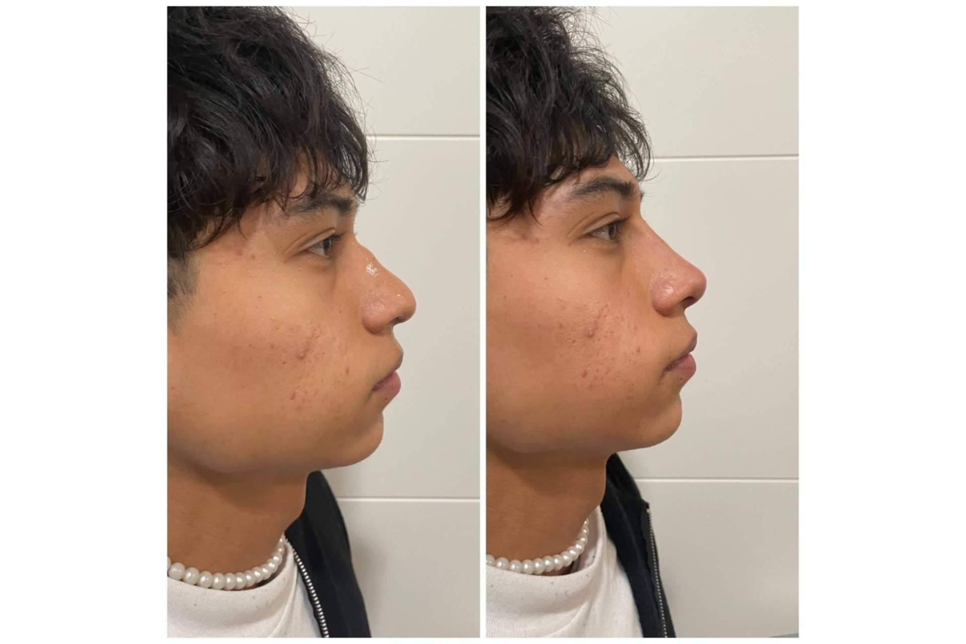 Rinomodelación sin cirugía de forma exitosa en Cecilia Arthur