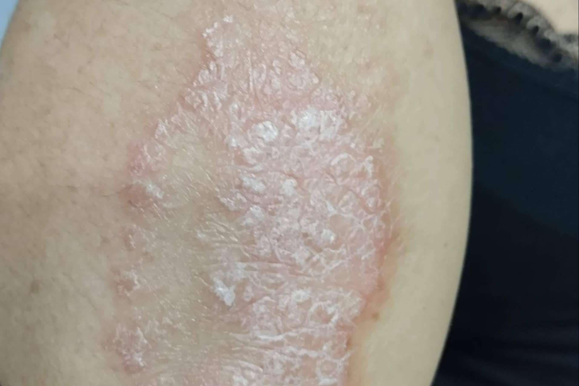 Tratando los problemas de la piel a través de la acupuntura y fototerapia, de la mano de Nüwa