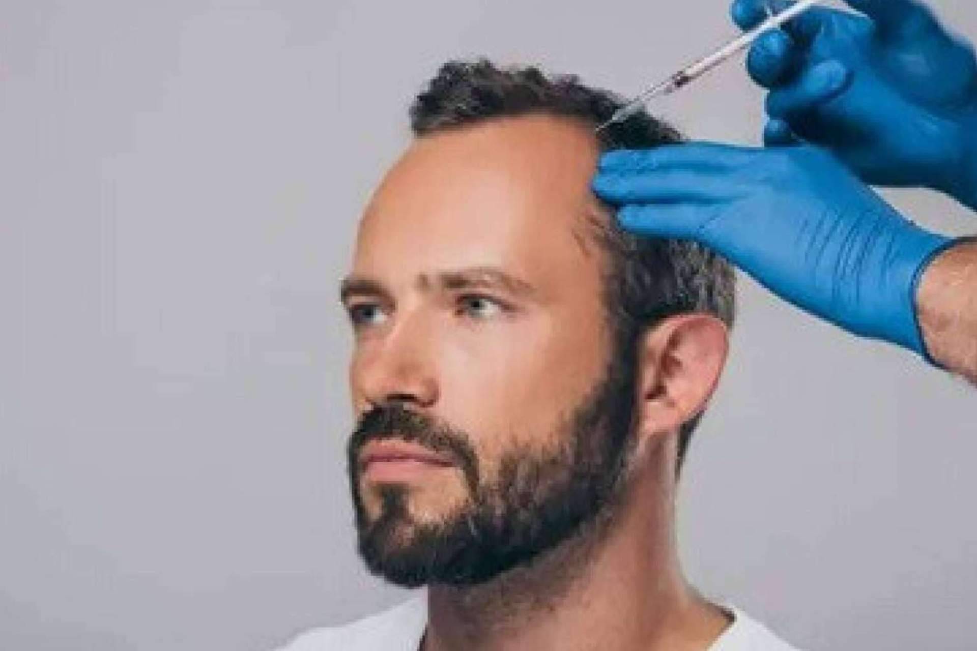 La mesoterapia capilar es un tratamiento para la caída del pelo