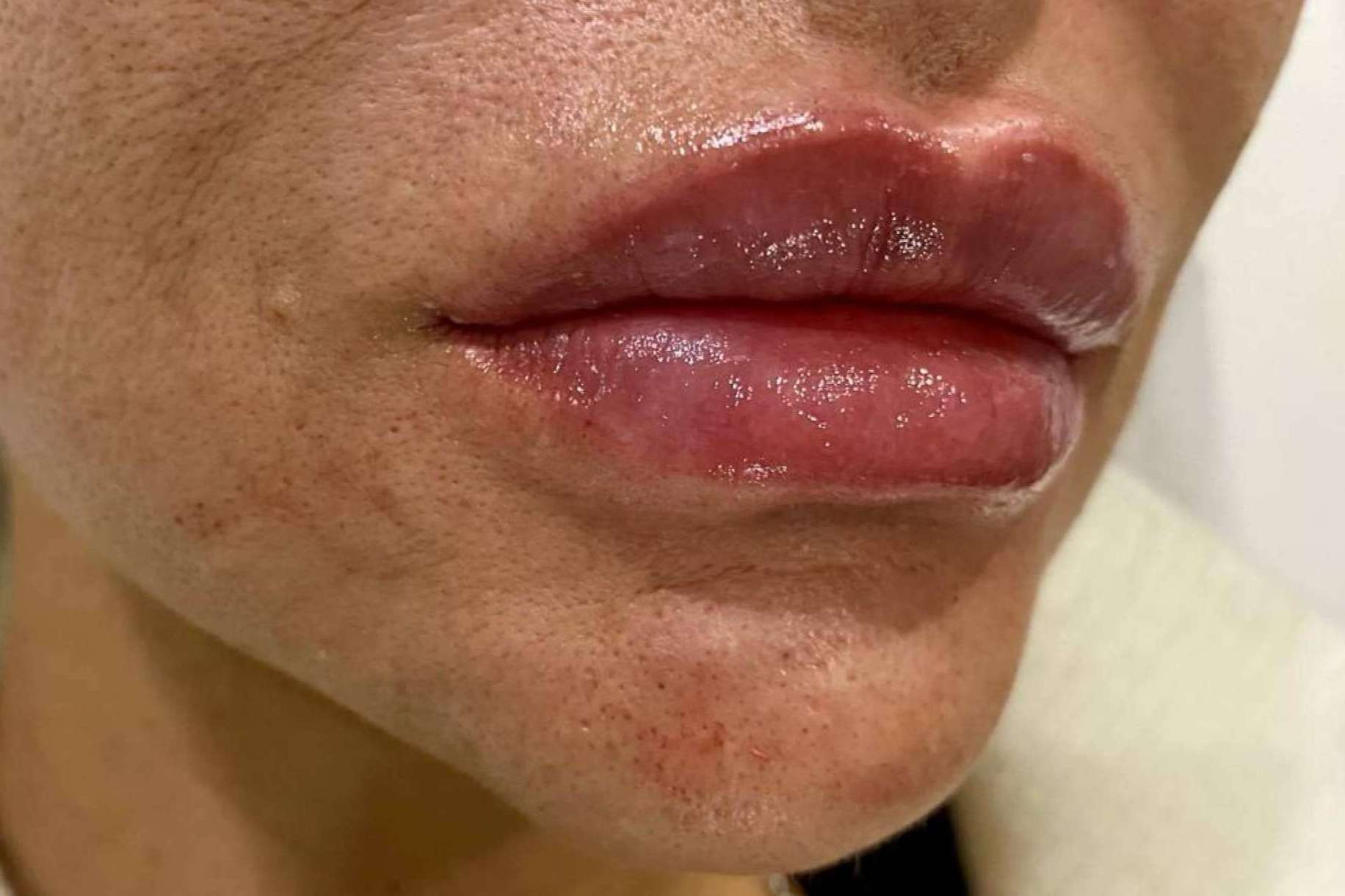 Aumento y remodelación de labios con ácido hialurónico