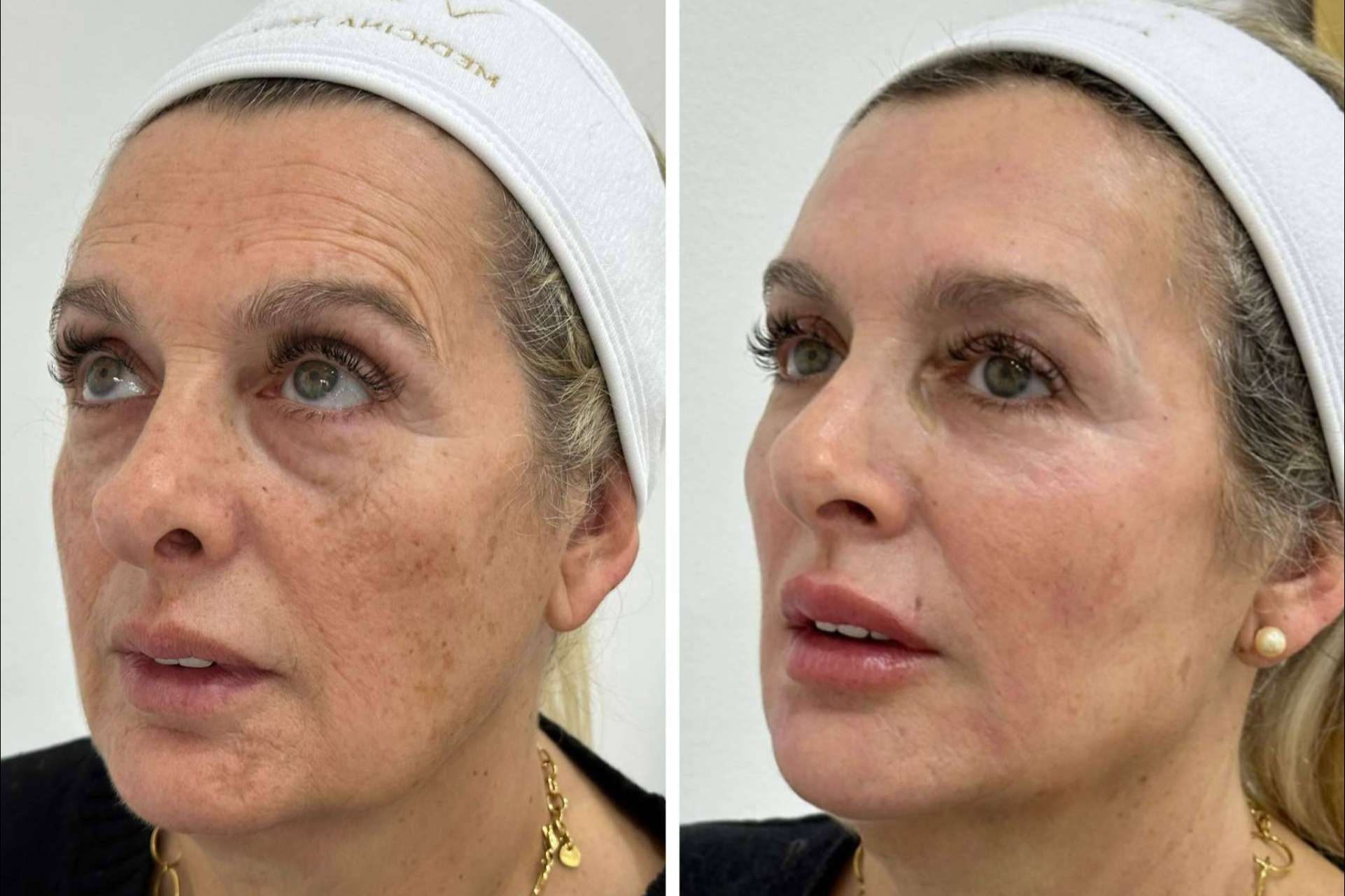 ¿Cómo combatir la flacidez facial?, por Clínica VISO