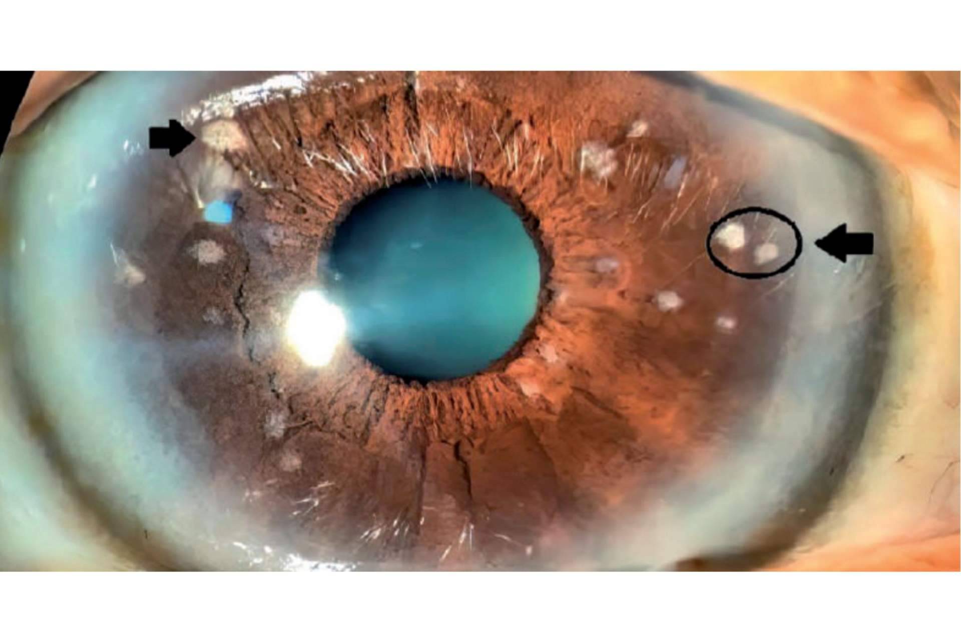 Tratamiento efectivo del vitiligo ocular mediante iridoplastia láser