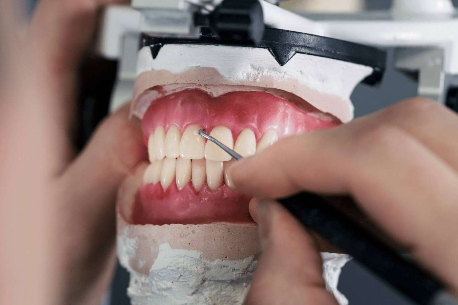 La Clínica Dental Ruiz de Gopegui coloca coronas dentales, una solución duradera y estética para recuperar la sonrisa perfecta