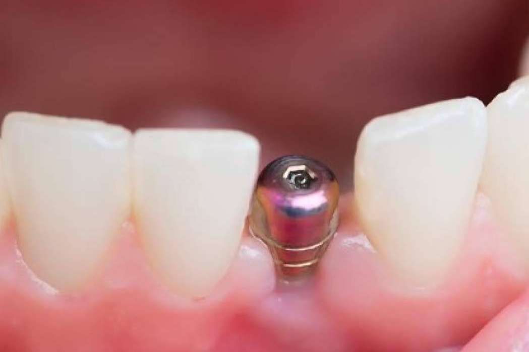 Toda la información necesaria sobre los implantes dentales de la Clínica Calvo de Mora